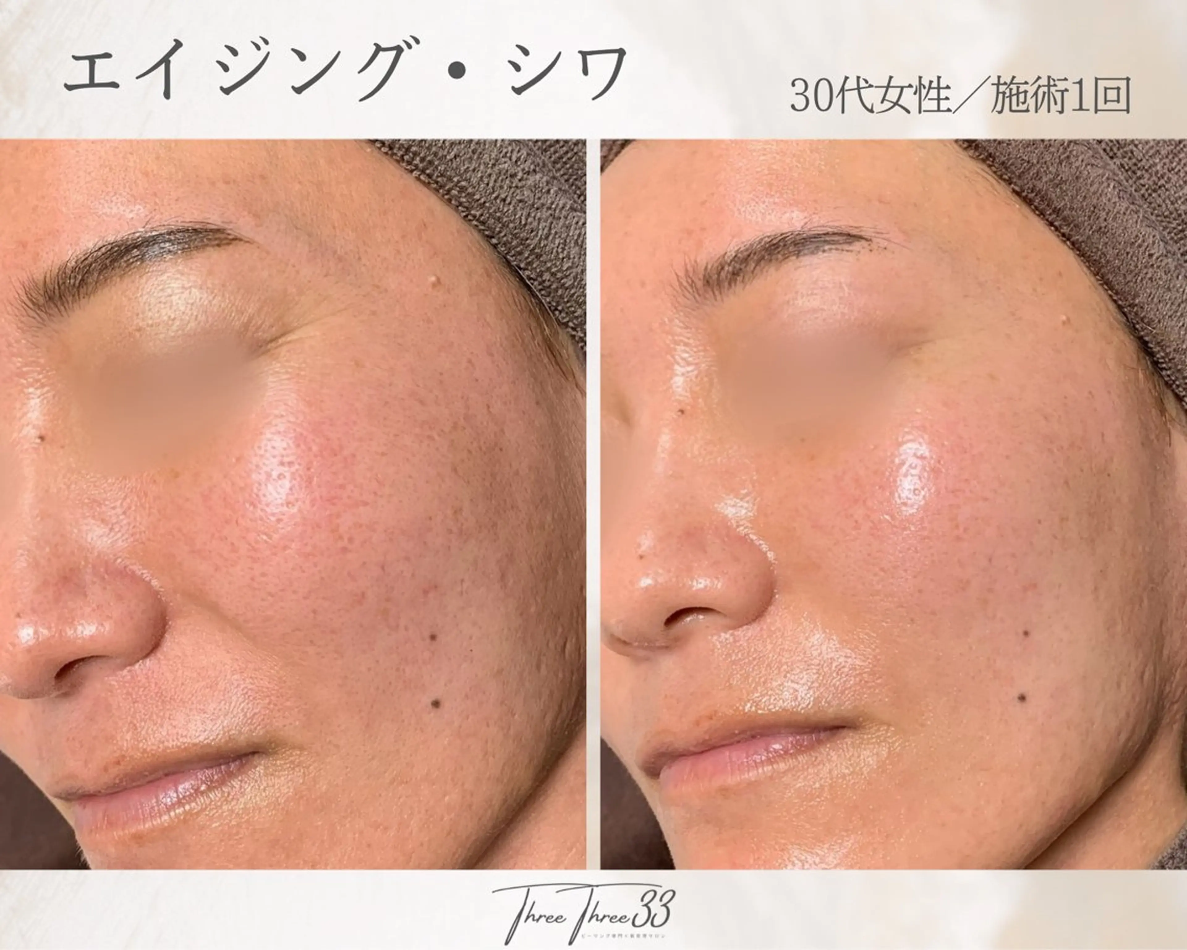 その他 ピーリング×肌管理 THREETHREEのエステ・リラクイメージ