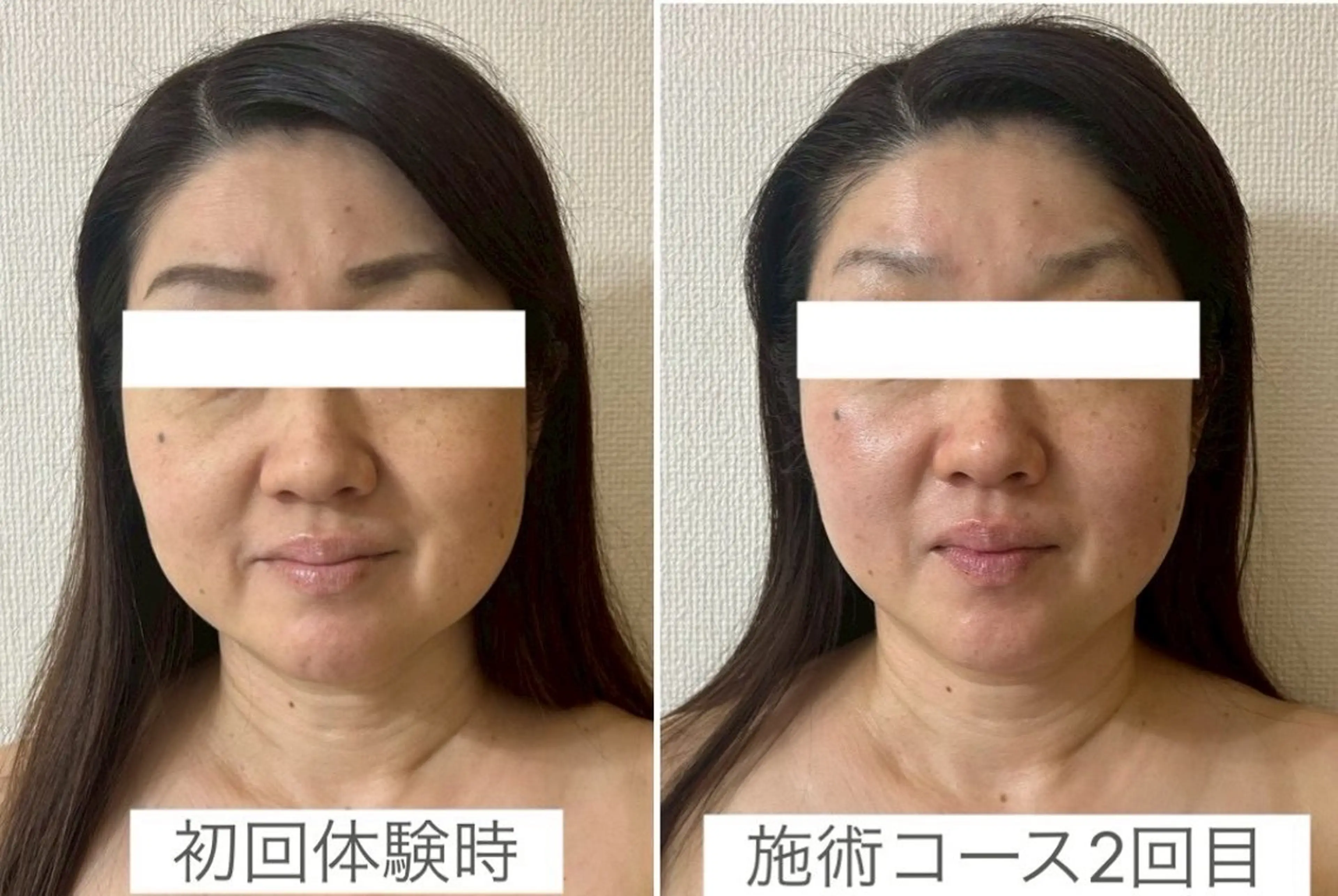 ブライダルプラン💍トライアングルフェイシャル®️３回コース(高濃度酵素化粧品一式セット付き)の写真