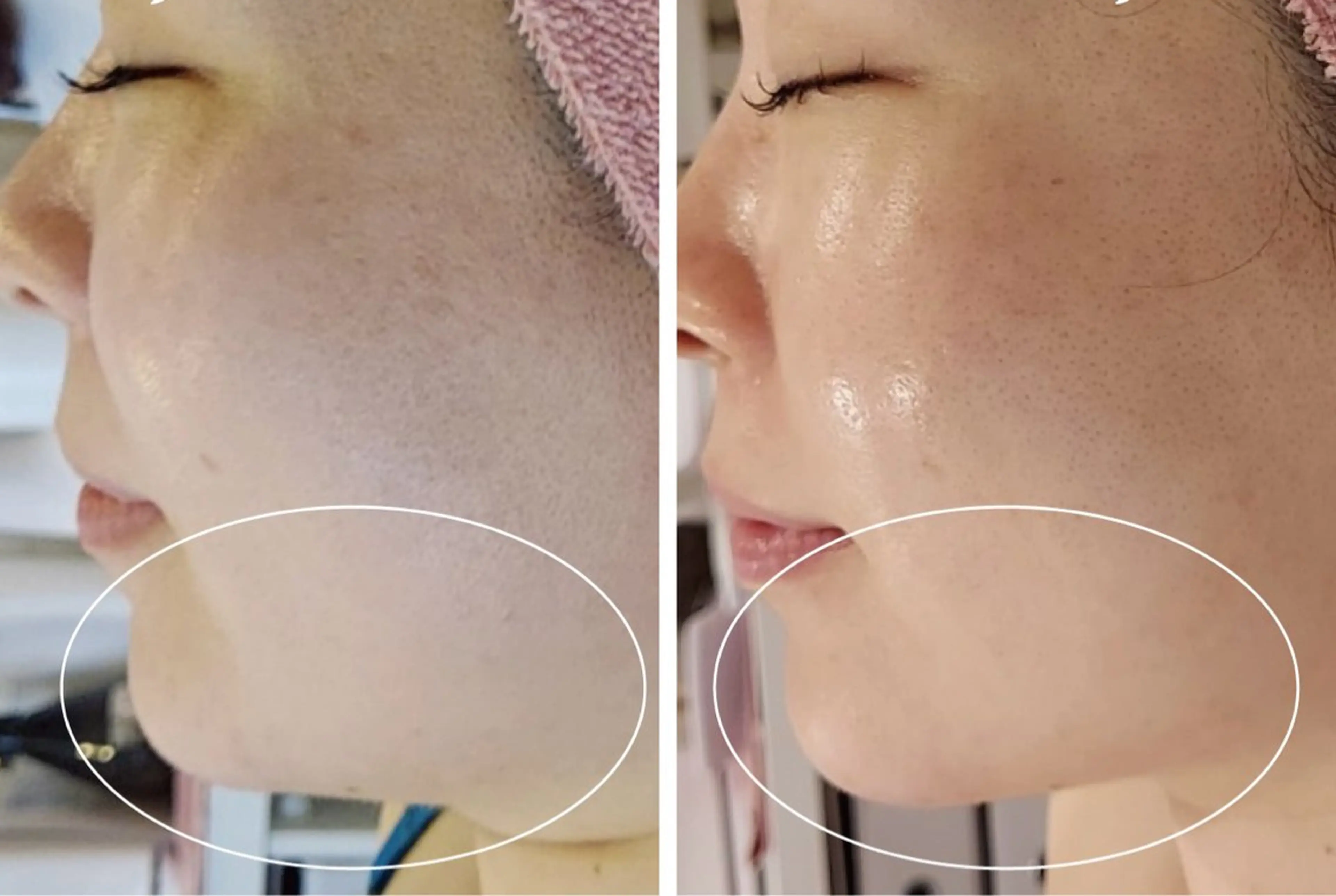 二重あごをグンッと引き上げ✨「切らない！痛くない！」小顔エステ💆‍♀️の写真