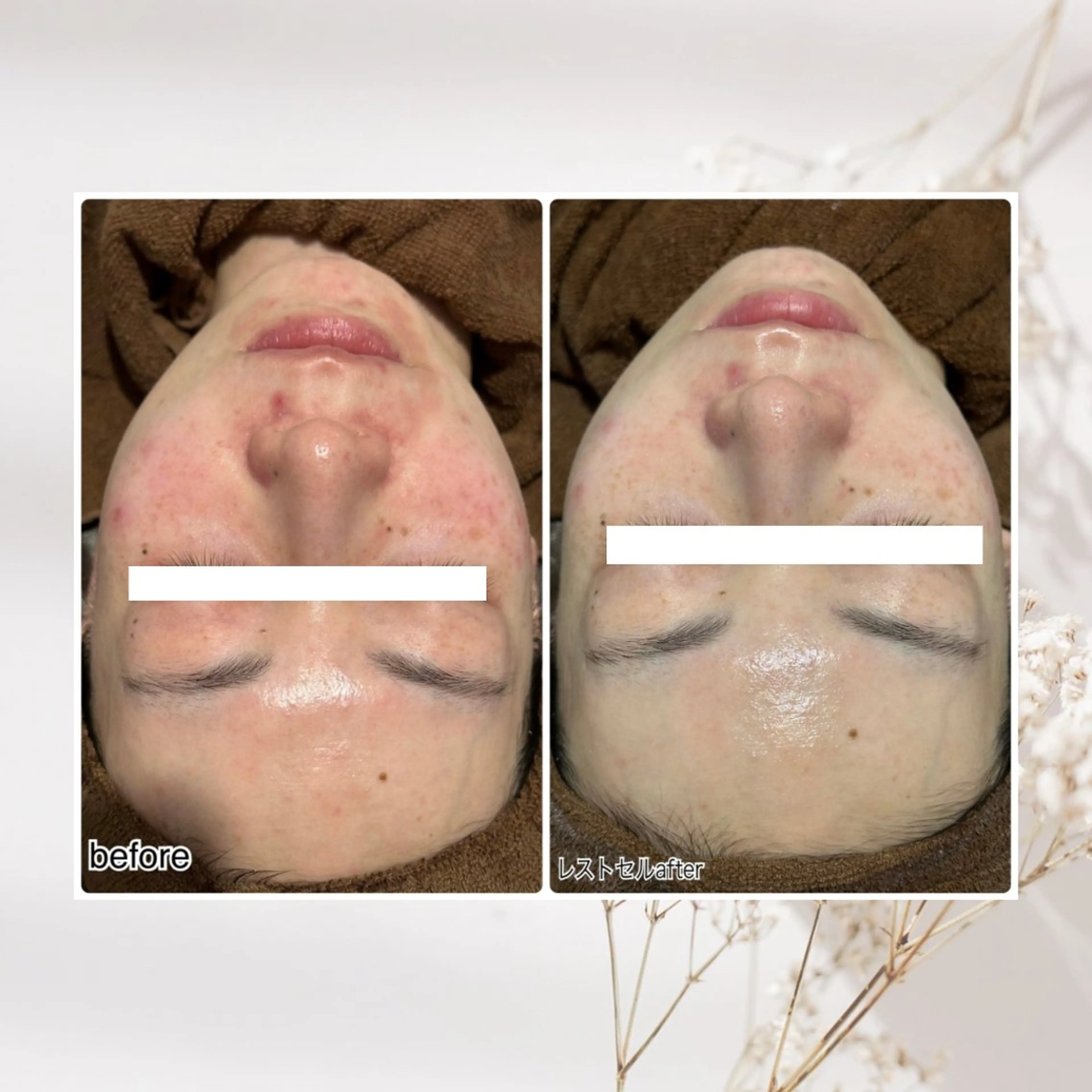 ENCHANT Kaede/肌質改善のその他イメージ