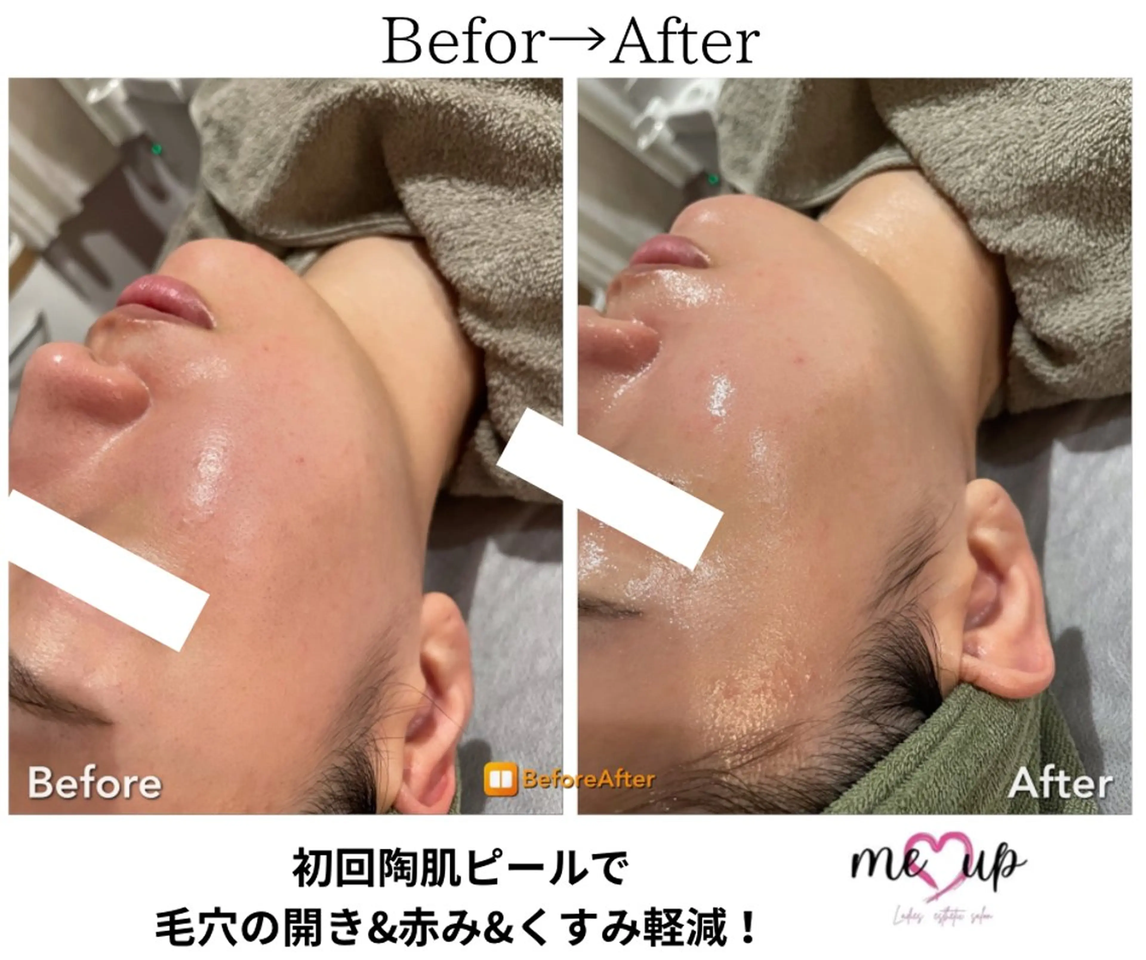 エステ Meupニキビ専門店 背中/ハーブ/肌管理のその他イメージ