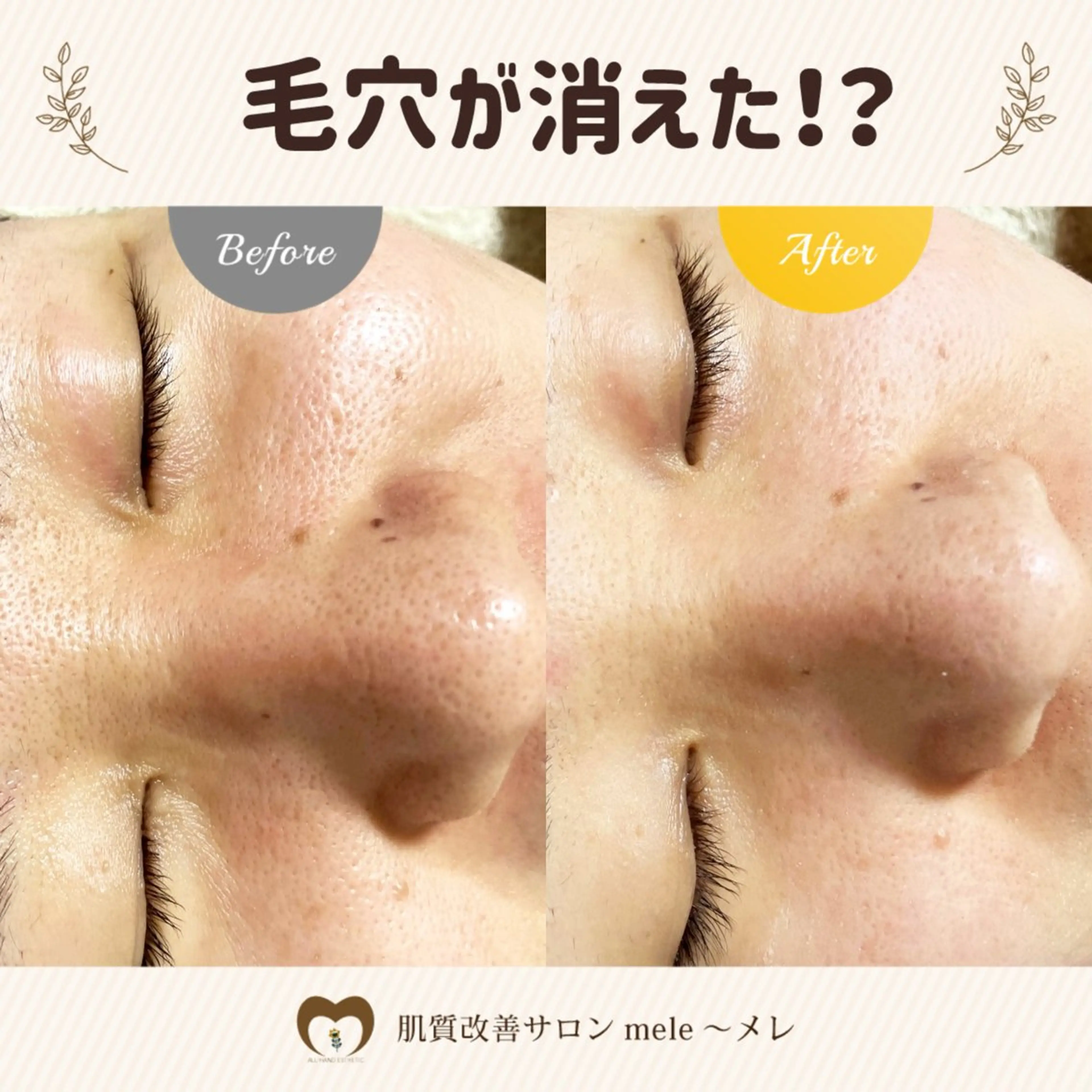 繰り返すニキビ・毛穴 ✨つくば肌質改善専門のエステ・リラクイメージ
