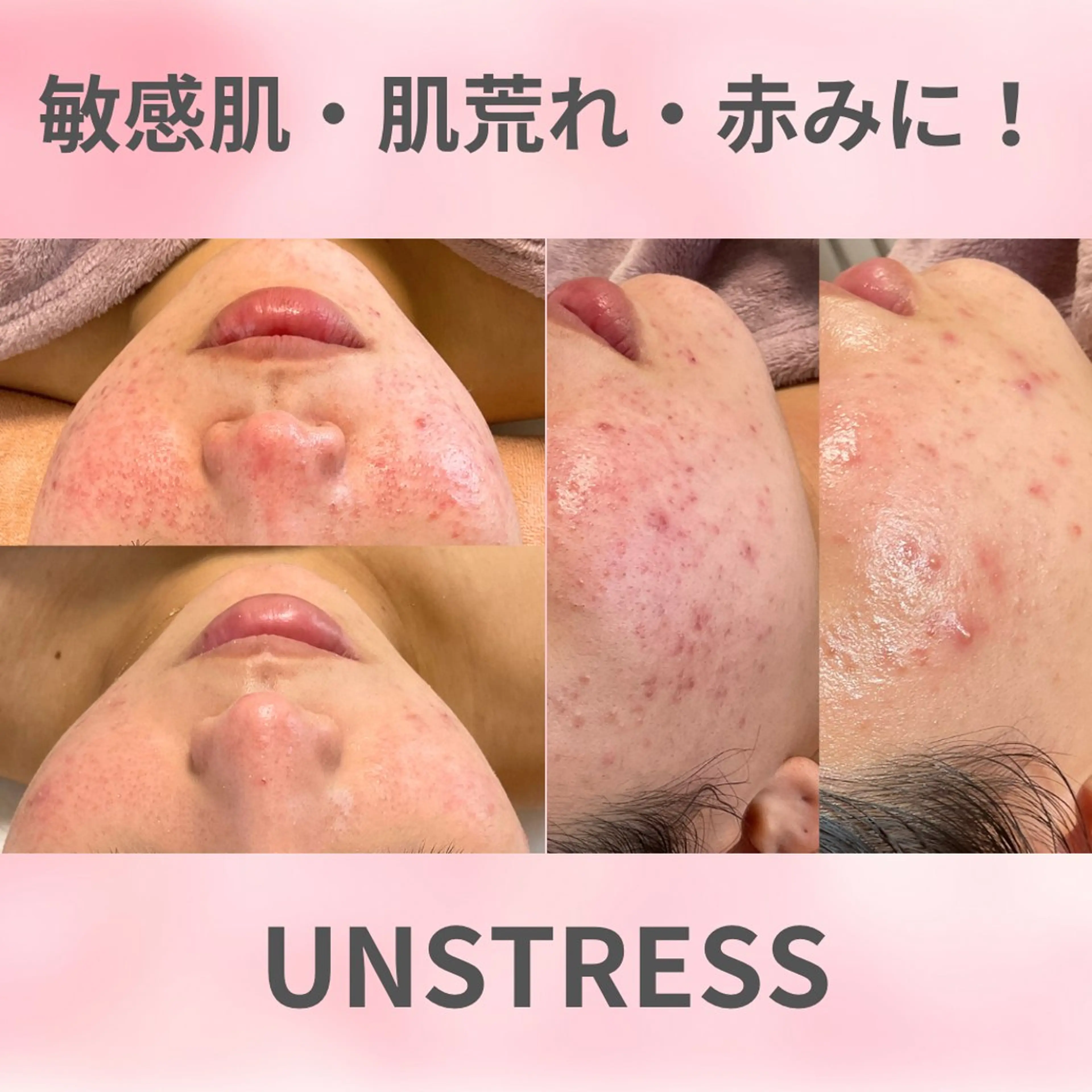 水光肌ミルクピーリング〝アンストレス〟🩵繰り返す肌荒れ・かゆみ・ごわつき・敏感肌にはこれ！ダウンタイム無し✨の写真