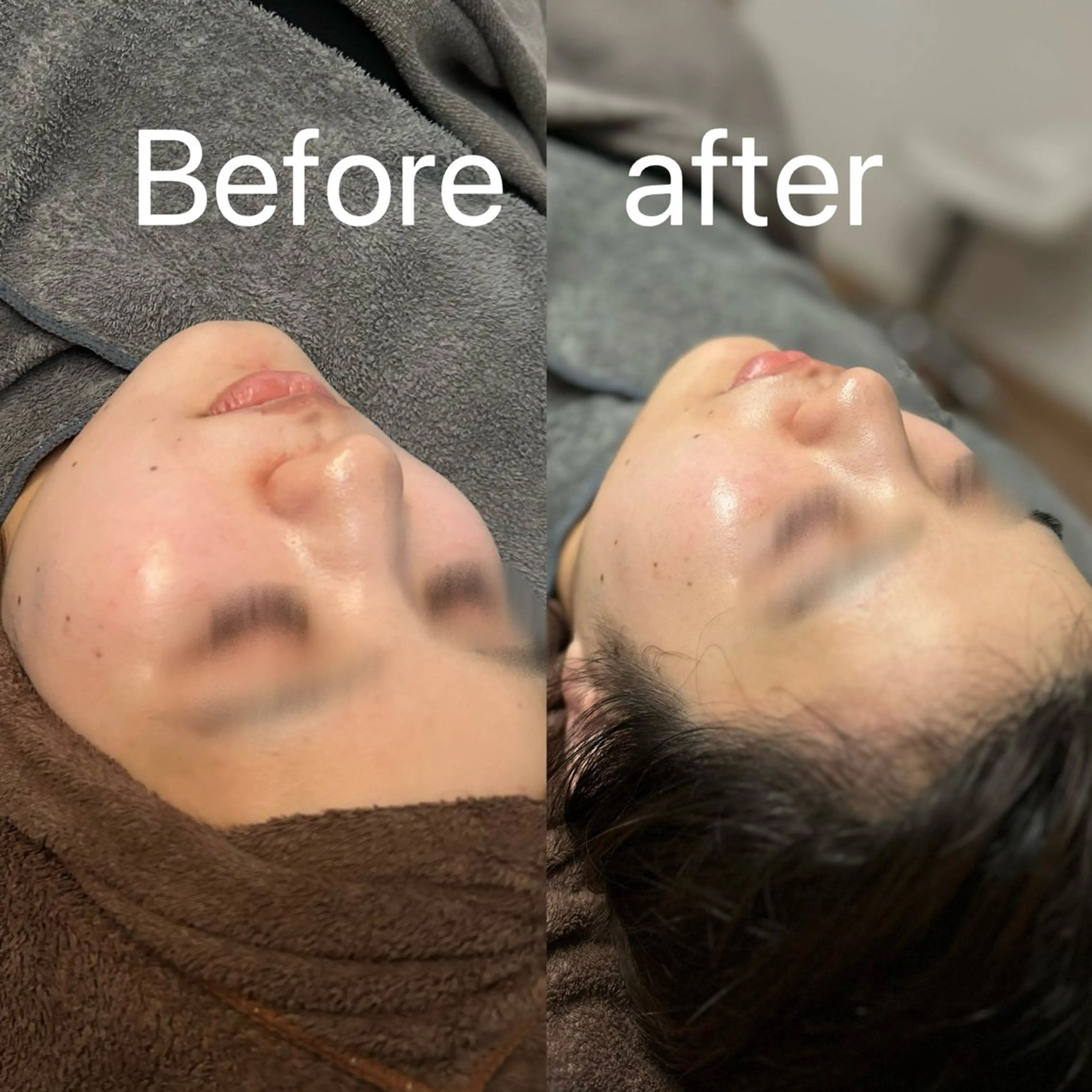 【モニター限定クーポン】肌質改善ハーブピーリング🌿の写真