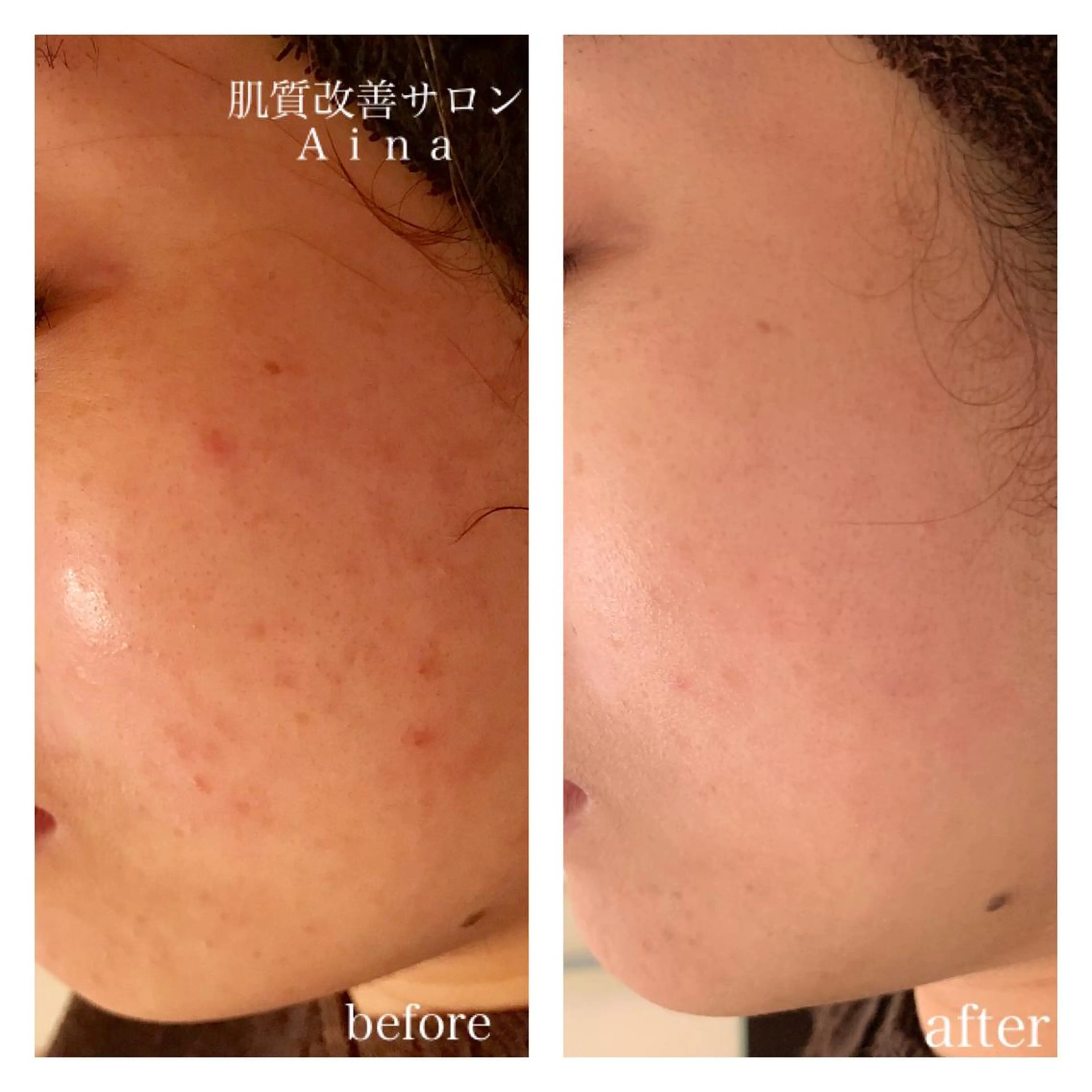 セミロング カラー パーマ ヘアアレンジ メンズ キッズ ネイル マツエク・マツパ エステ リラク ニキビ跡専門サロン Ainaのエステ・リラクイメージ