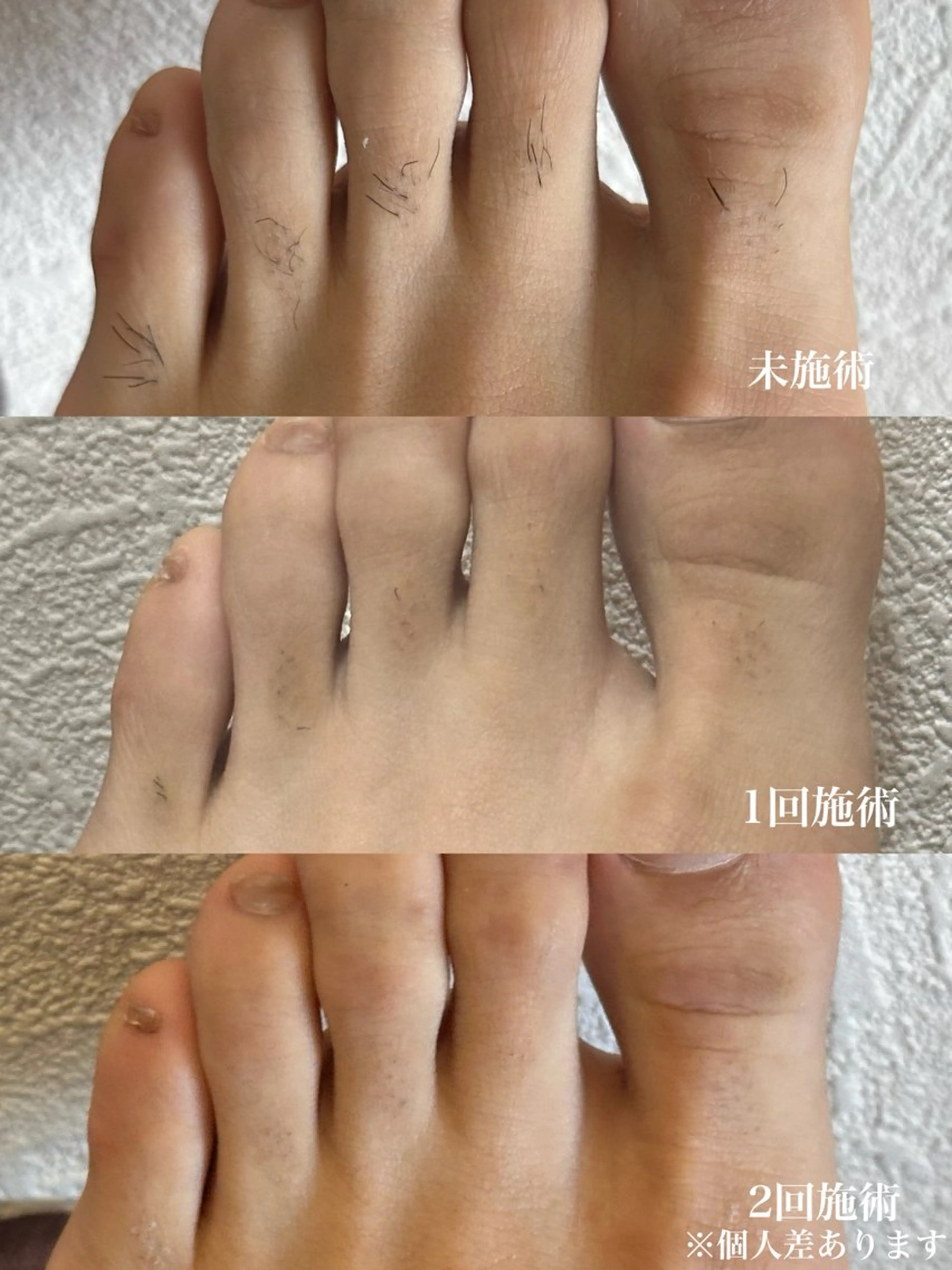 メンズ 脱毛 muumo所属・muumo まりののエステ・リラクイメージ