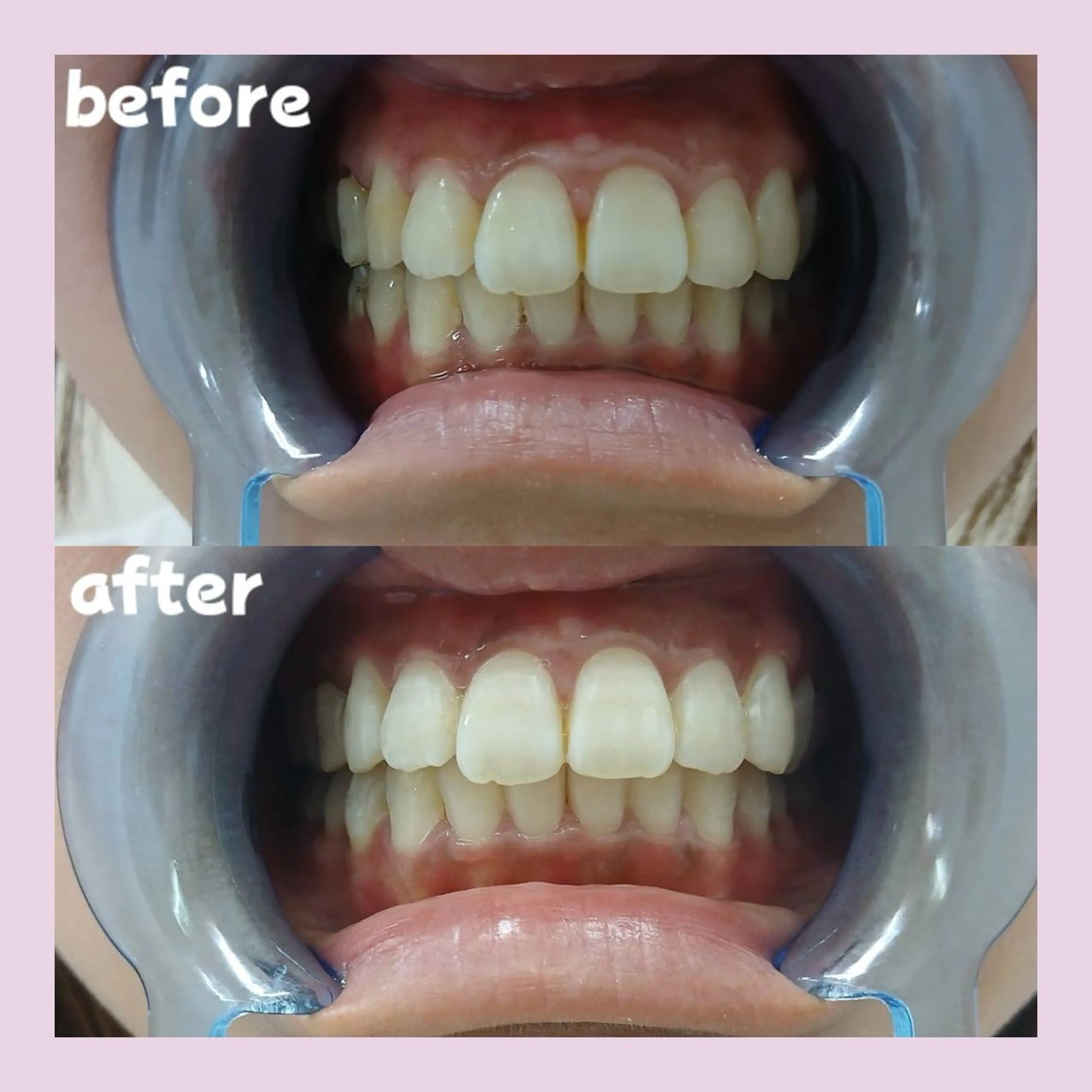 セルフホワイトニング30分照射の写真