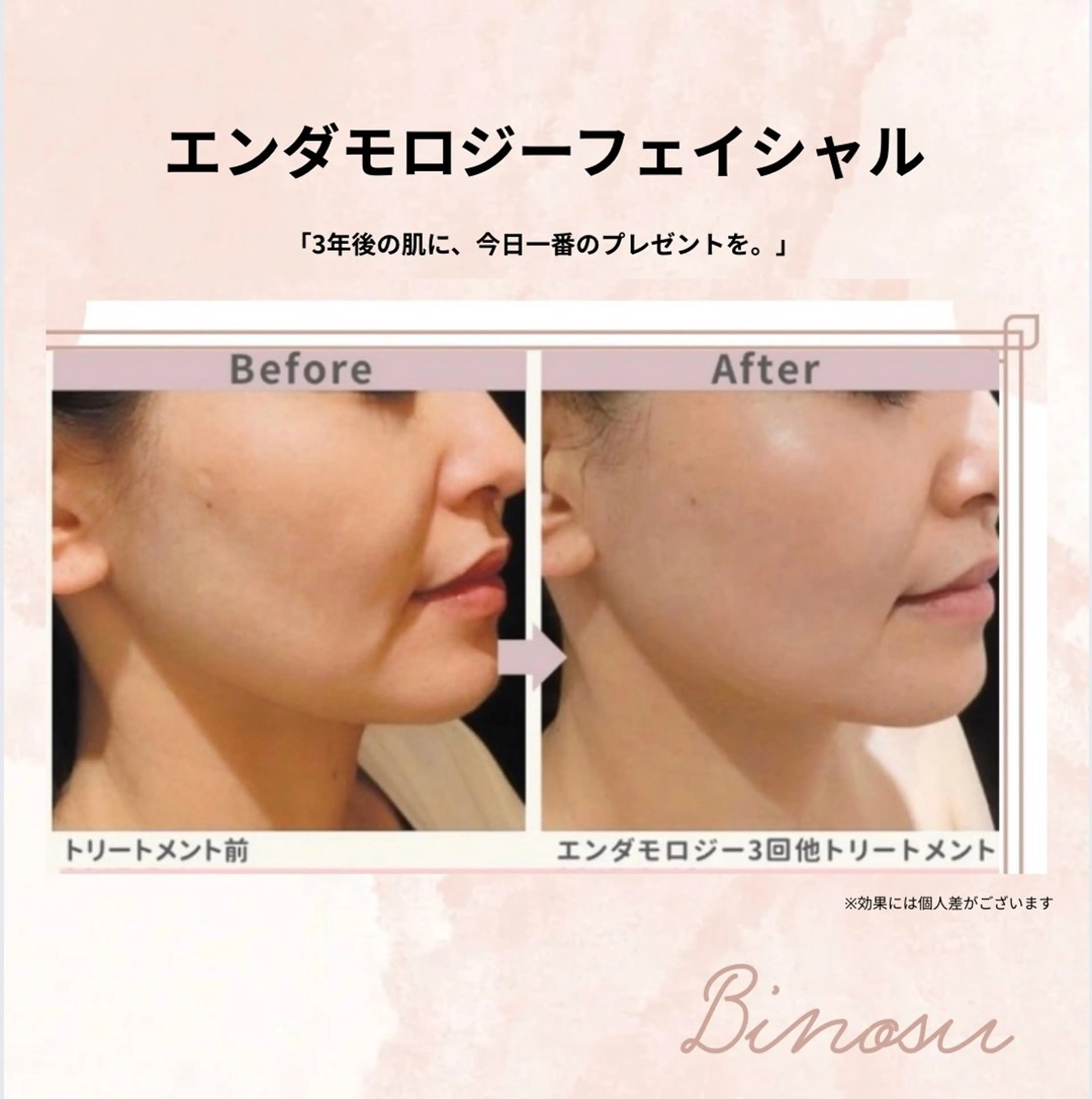 本気のリフトケア【エンダモロジー】顔の重み・もたつき解消!毛穴洗浄×美容液導入で驚きのツヤ美肌へ(駐車場完備)の写真