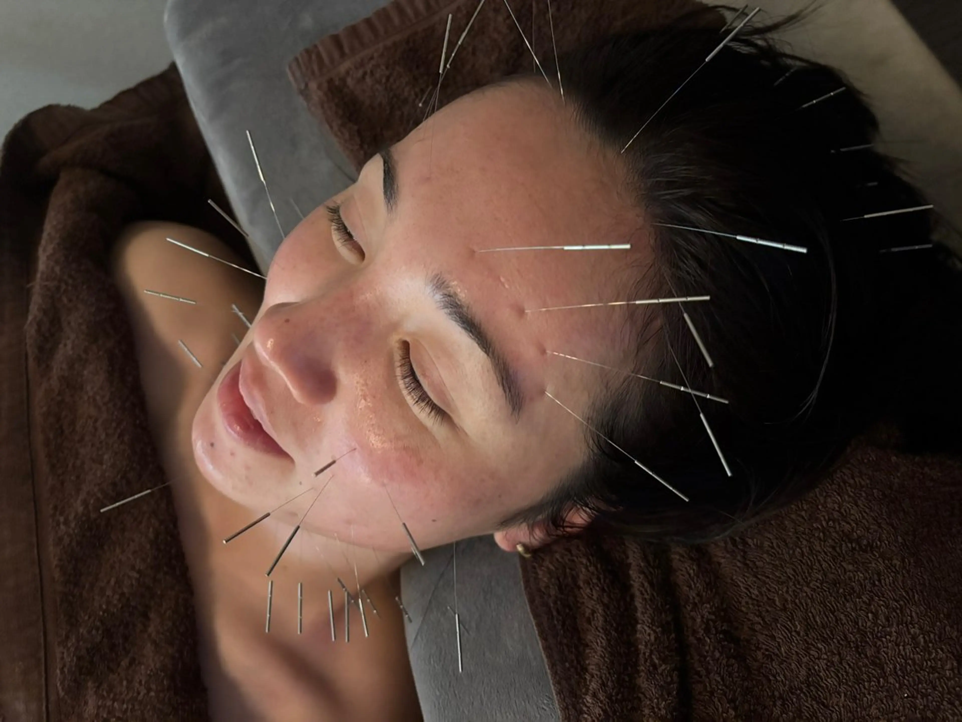 エステ 圧倒的たるみ改善 美容鍼エステのエステ・リラクイメージ