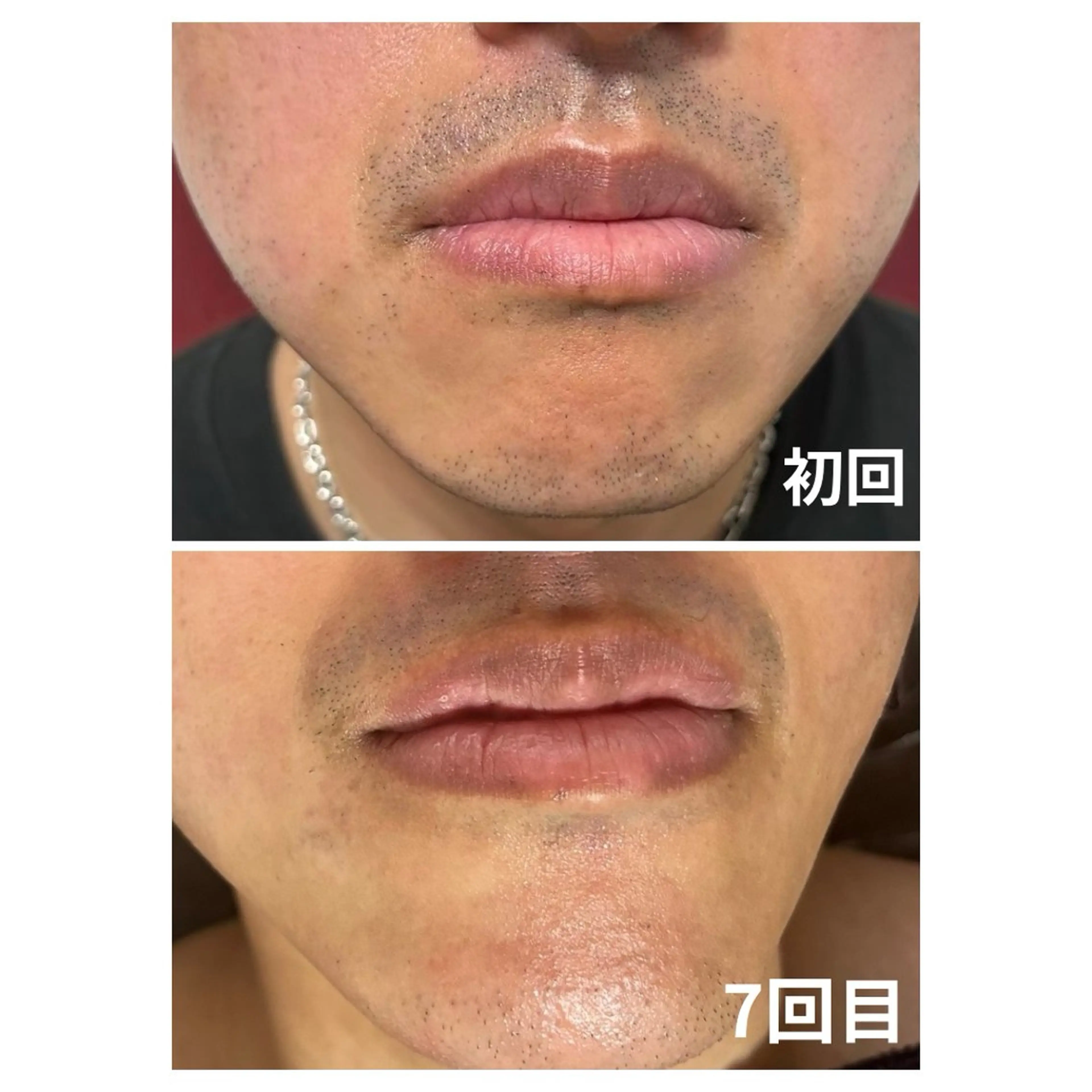 メンズ 脱毛 エマニエル USAのエステ・リラクイメージ