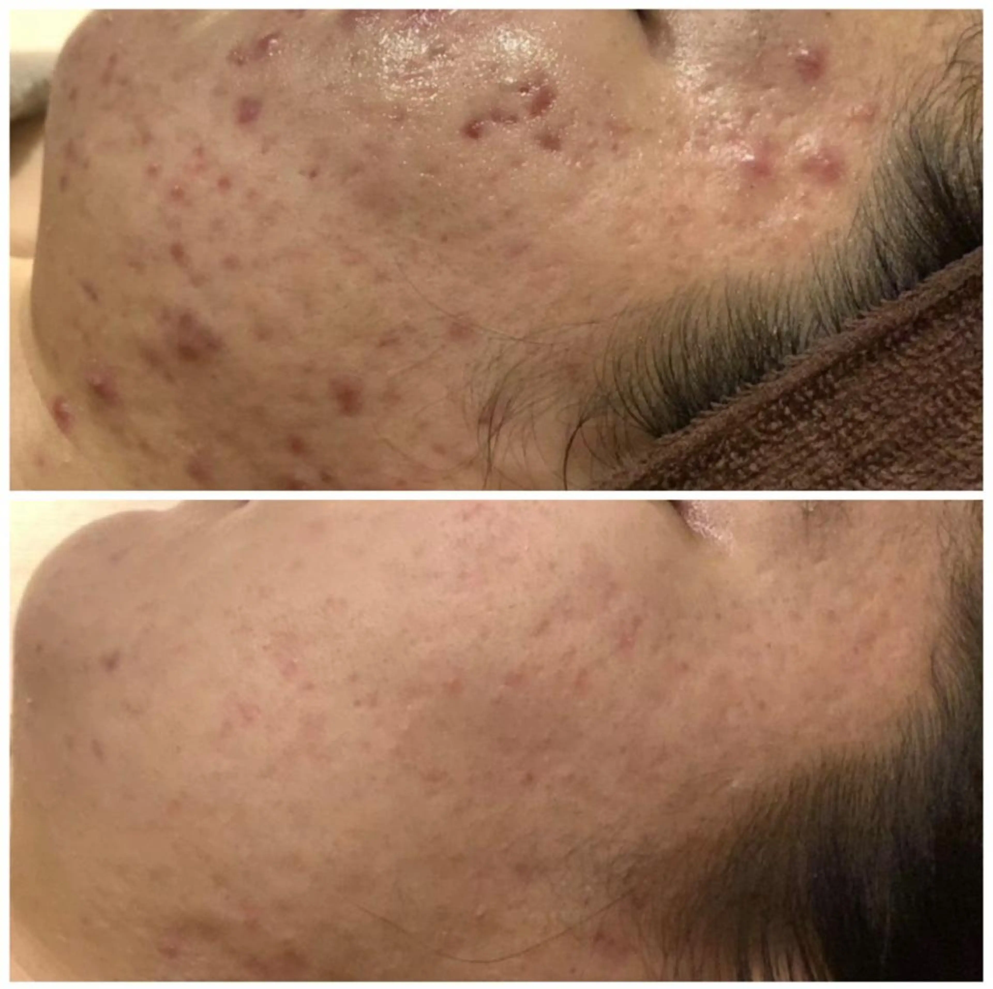 3か月で肌革命👼 ニキビ専門店💫のエステ・リラクイメージ