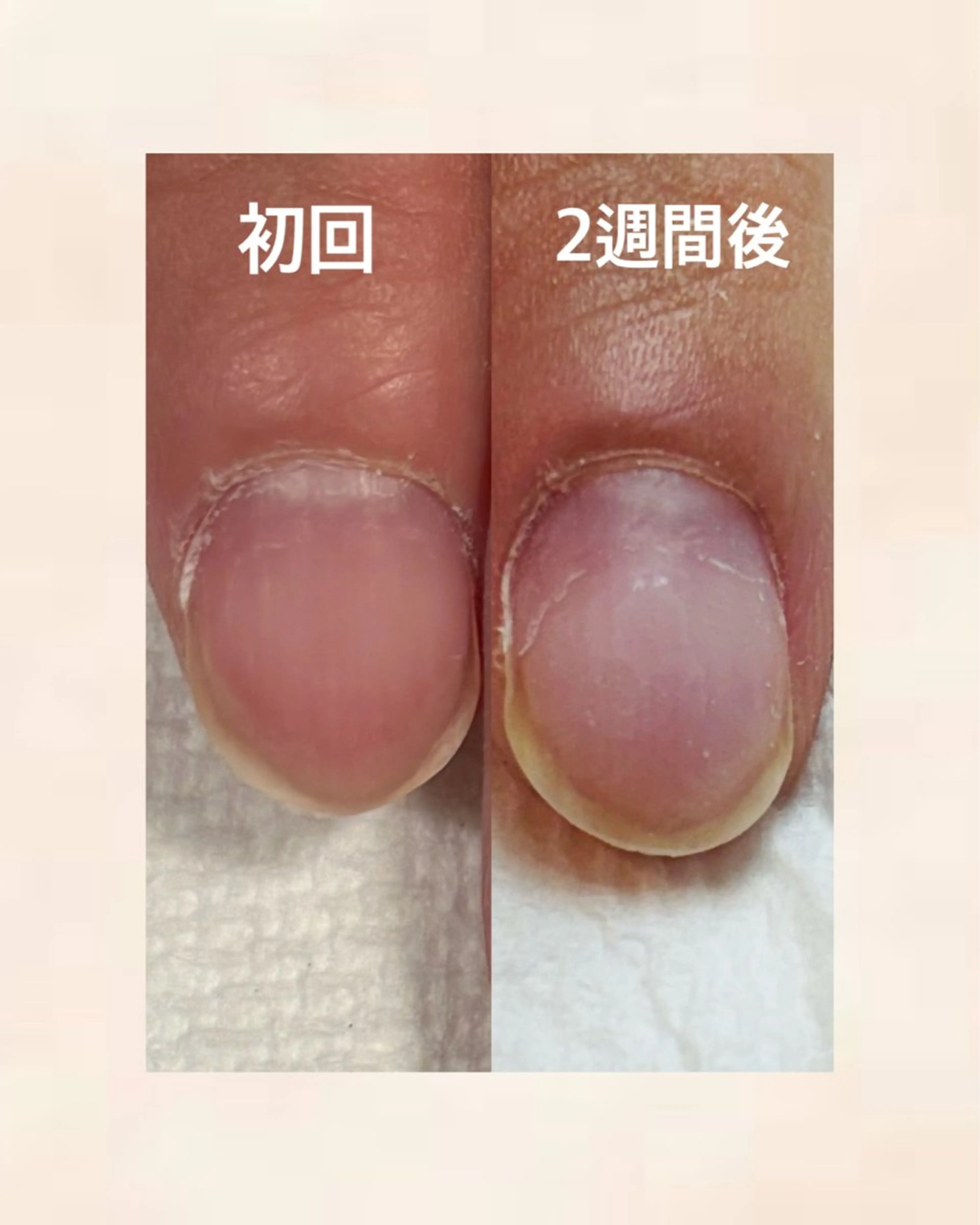 自爪矯正（初回）の写真