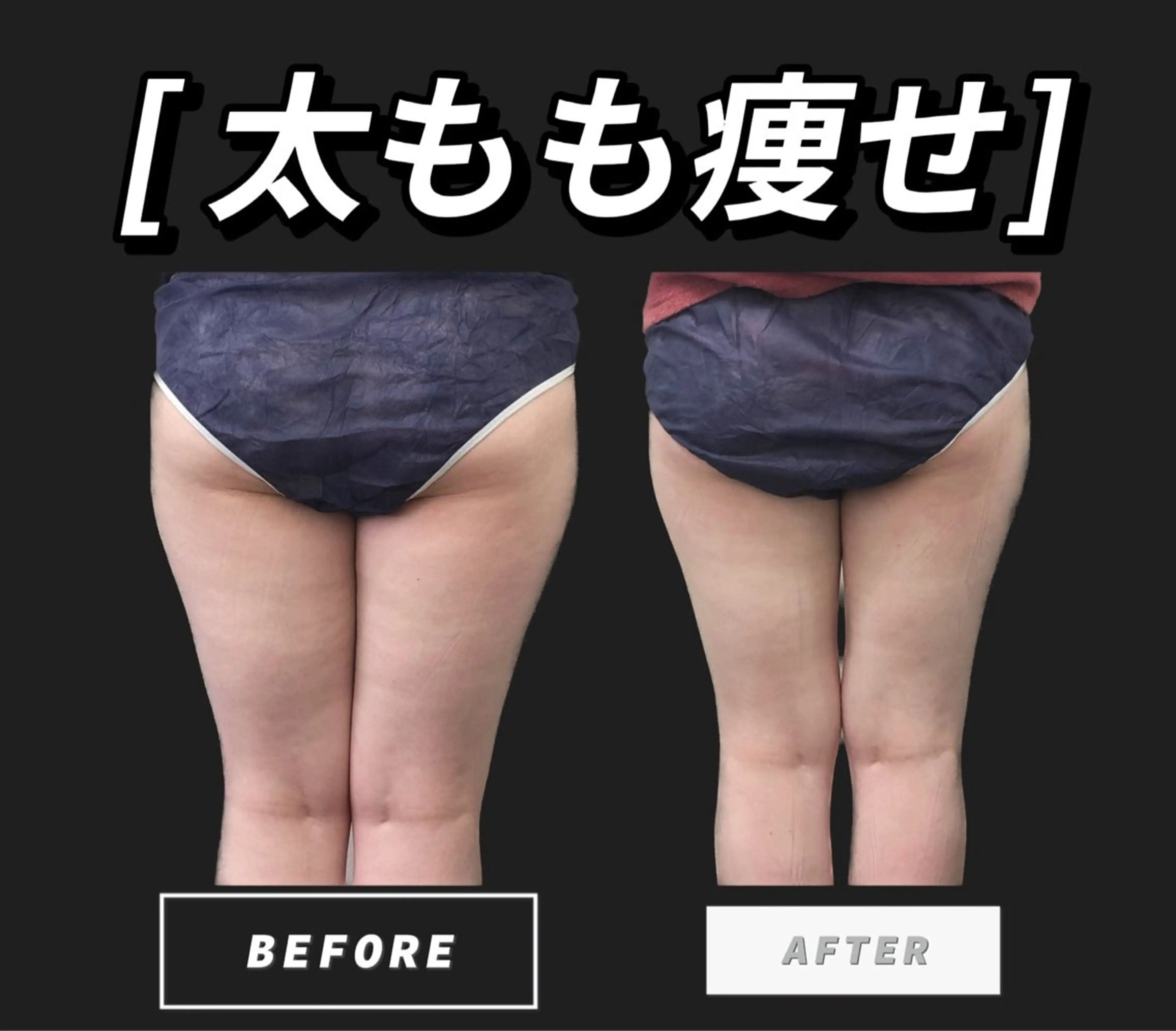 ⭐️丸っと下半身⭐️脚痩せ極🦵キャビテーション90分【ほぼマシーンかけ】の写真