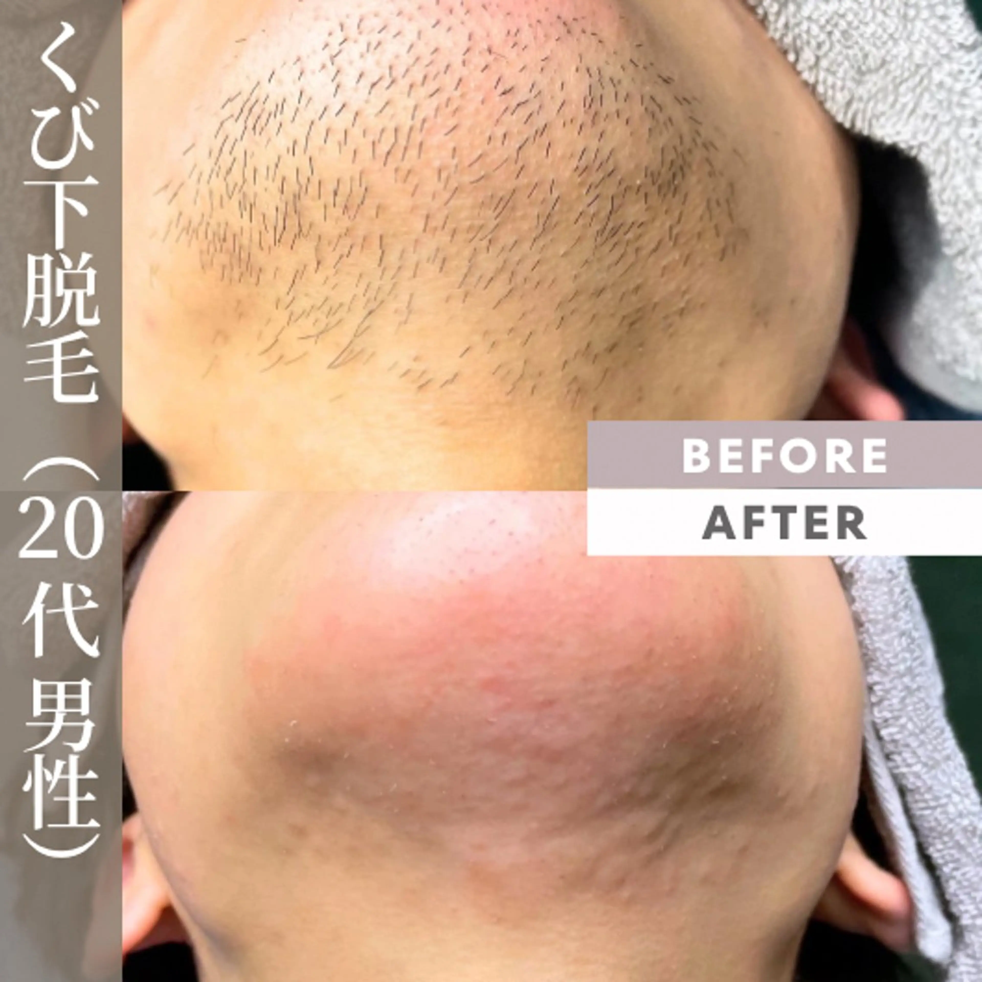 メンズ 【一本ずつ脱毛】 ReMove 柏のエステ・リラクイメージ