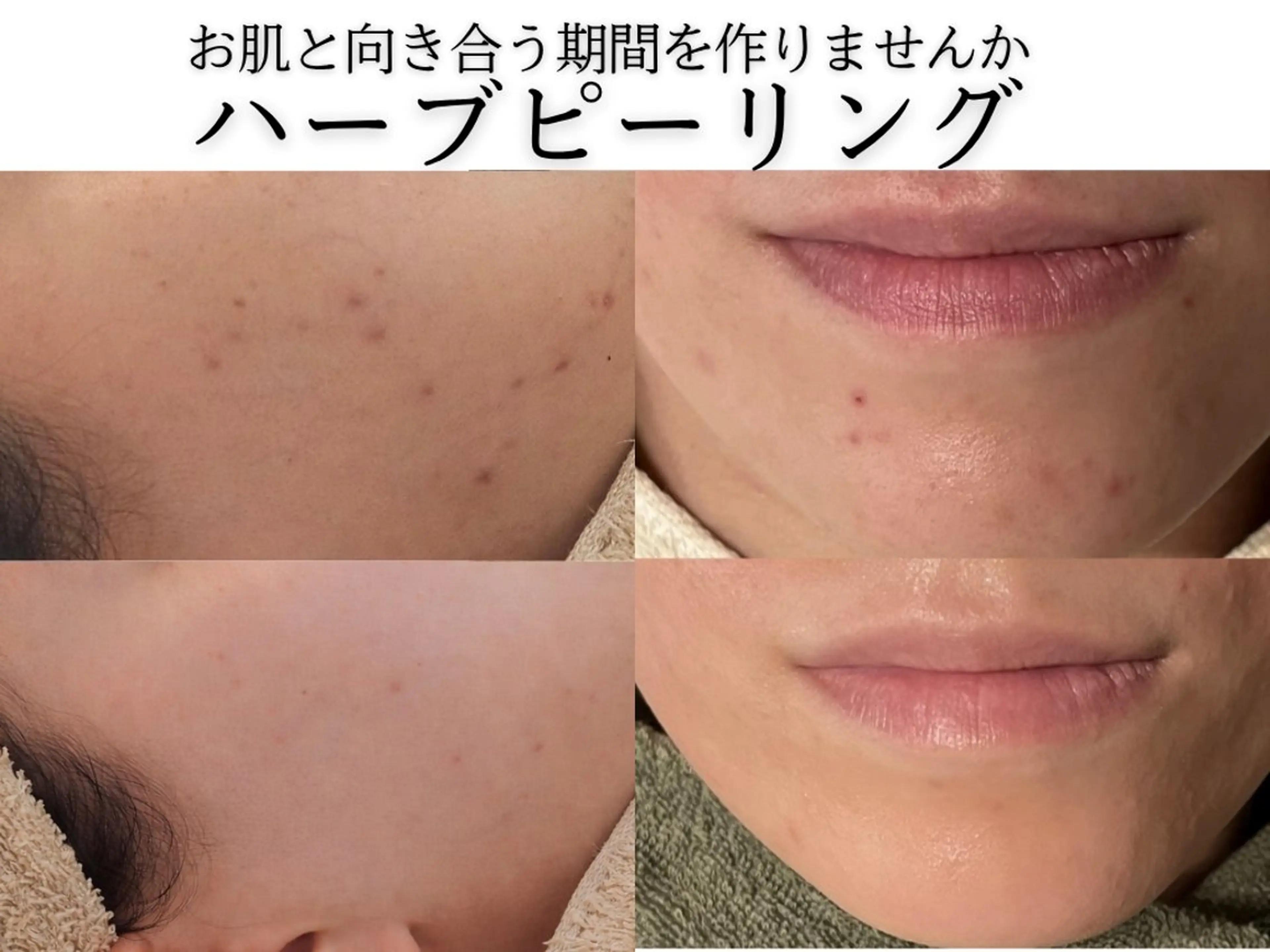 【剥離あり】ハーブピーリングの写真