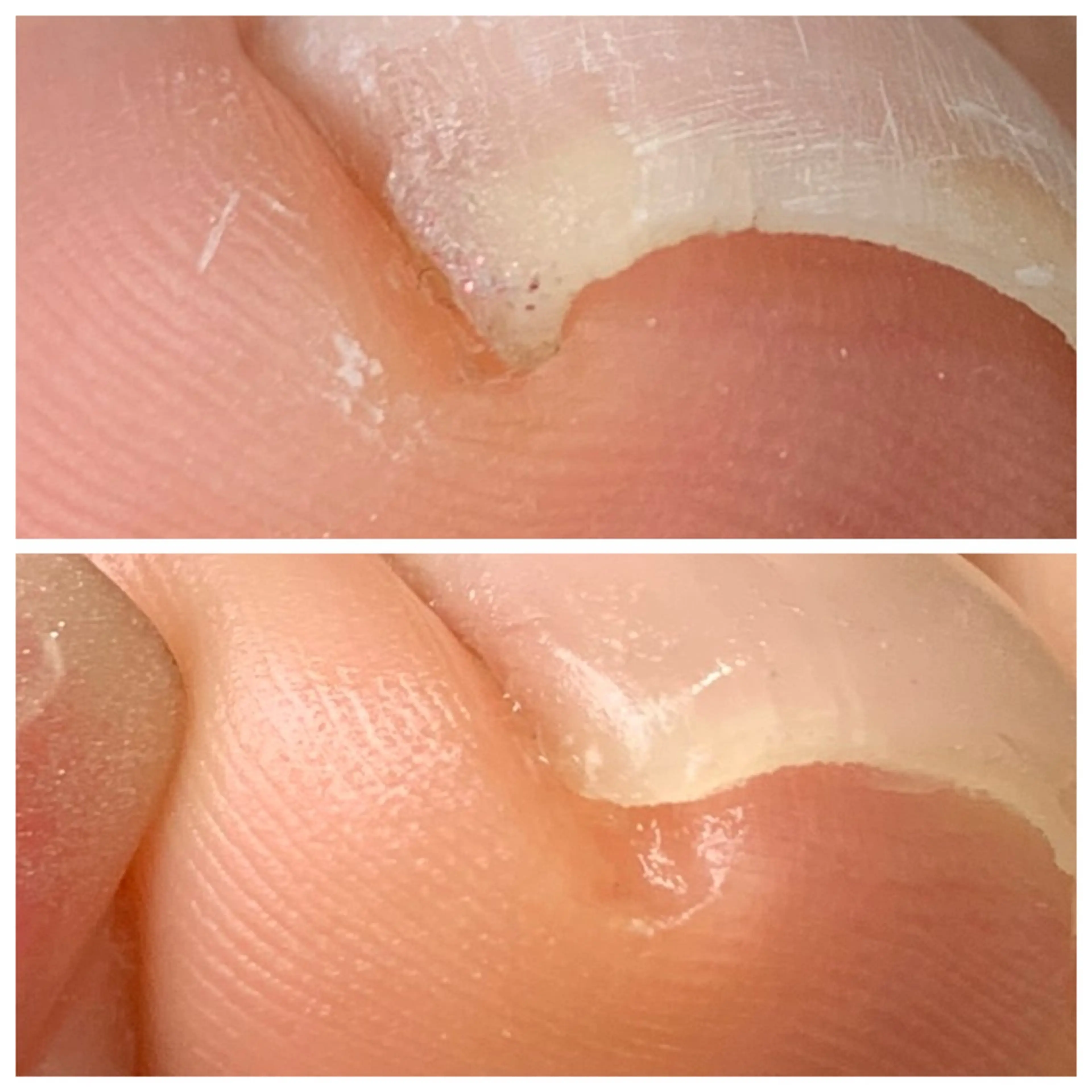 巻き爪、陥入爪 親指1本の写真