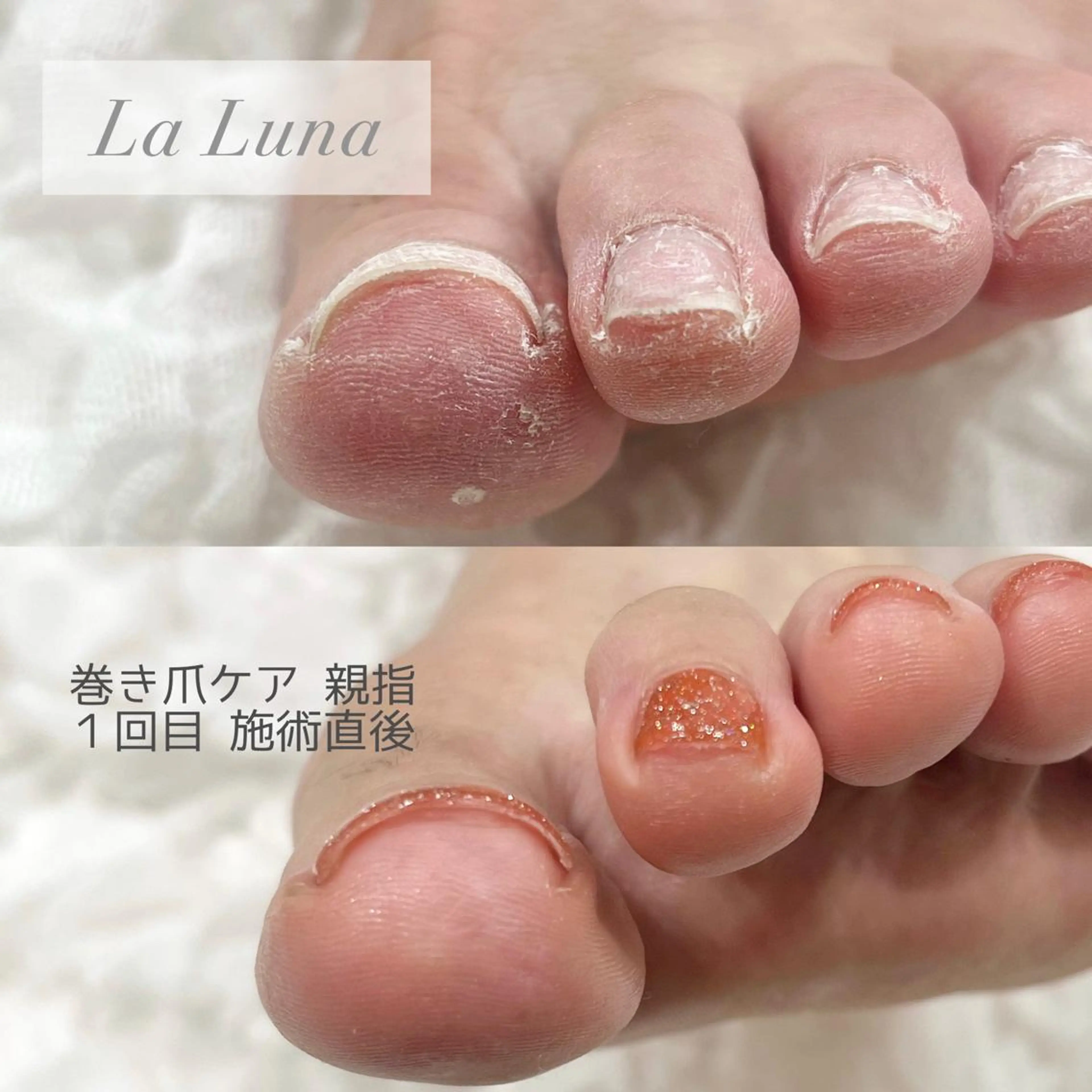 💙　フット 巻き爪ケア(1本)の写真