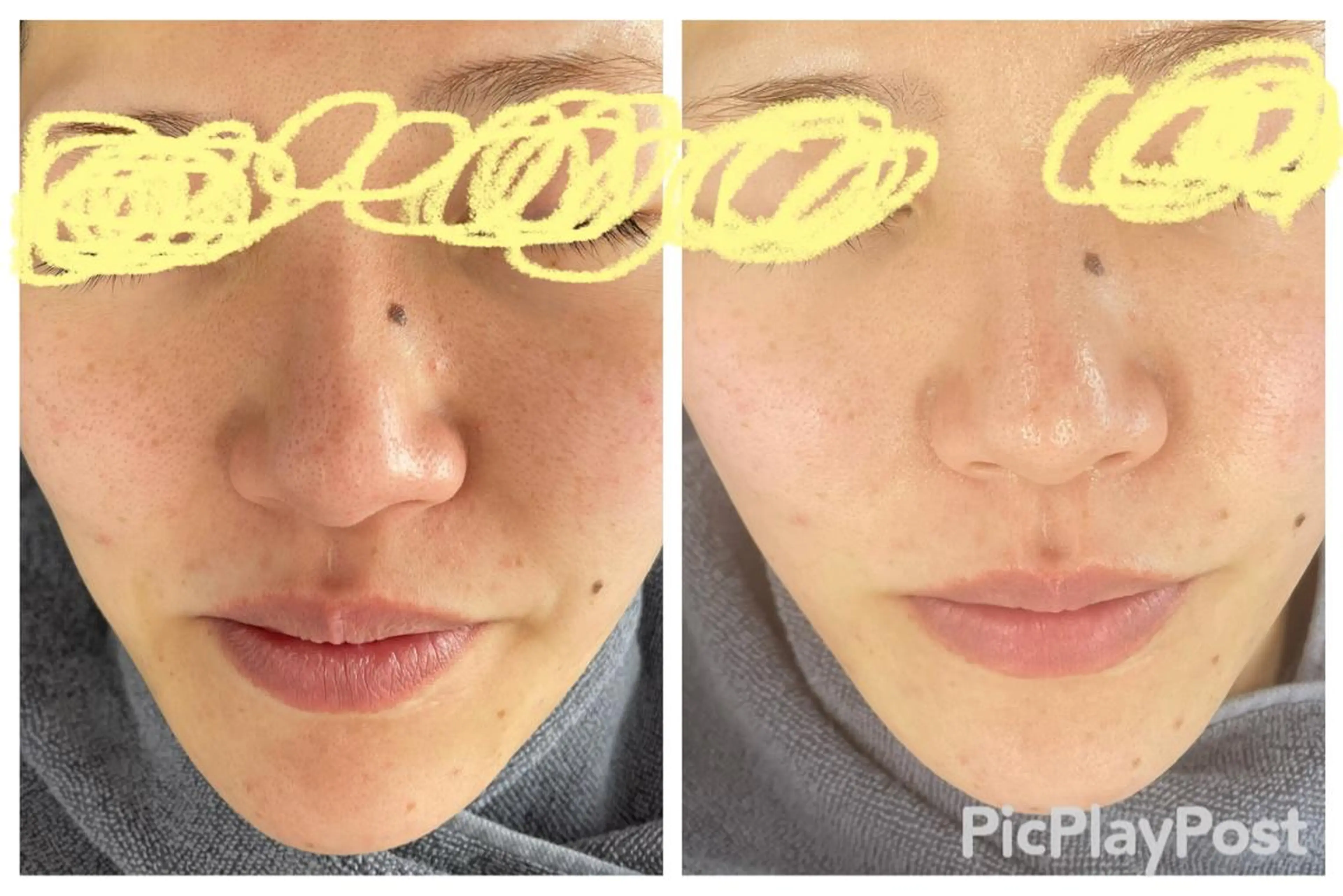 【角質除去】お肌に優しいとり過ぎないピーリング💎の写真