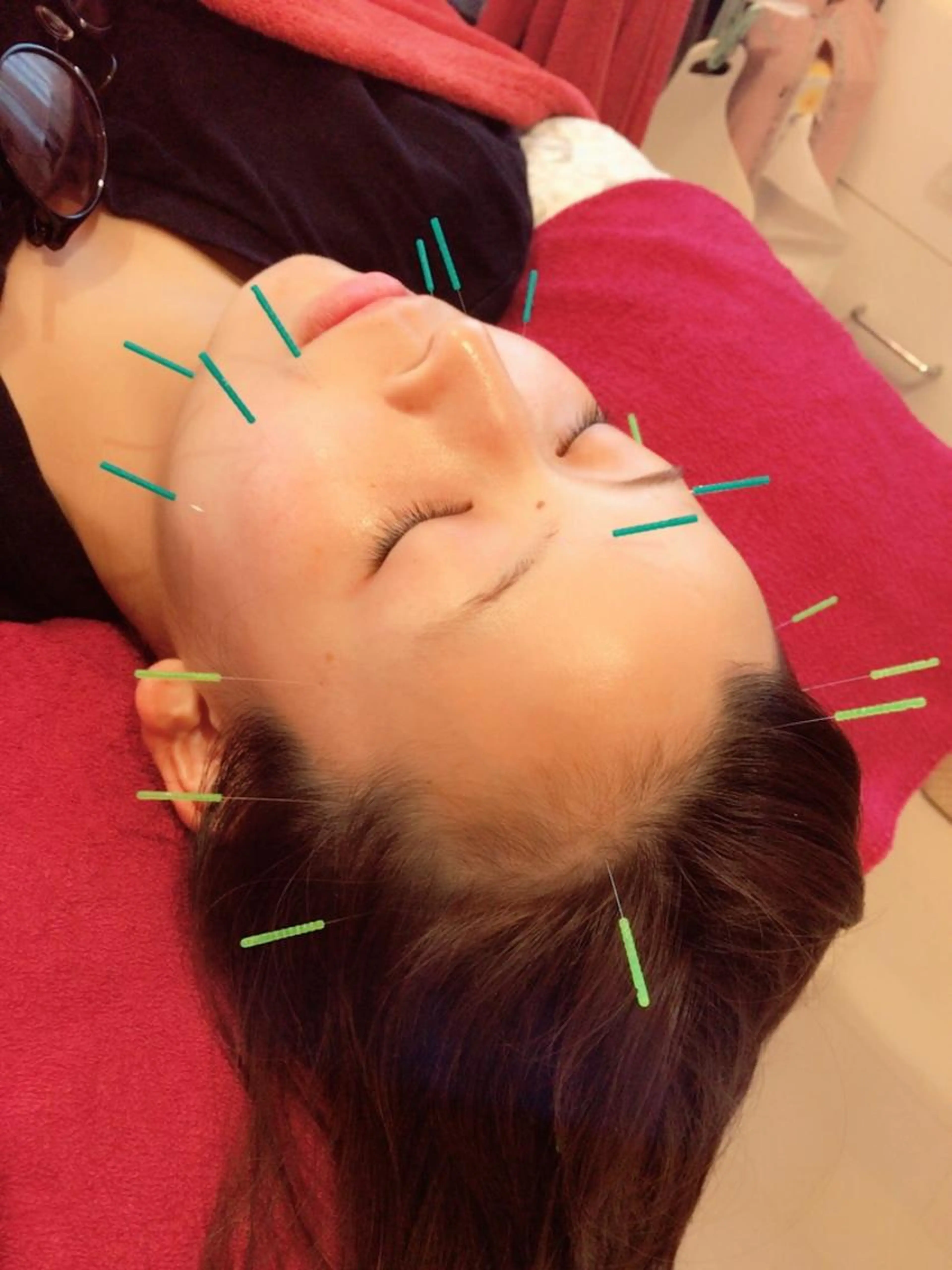 美容鍼(フェイスマッサージ込み)の写真