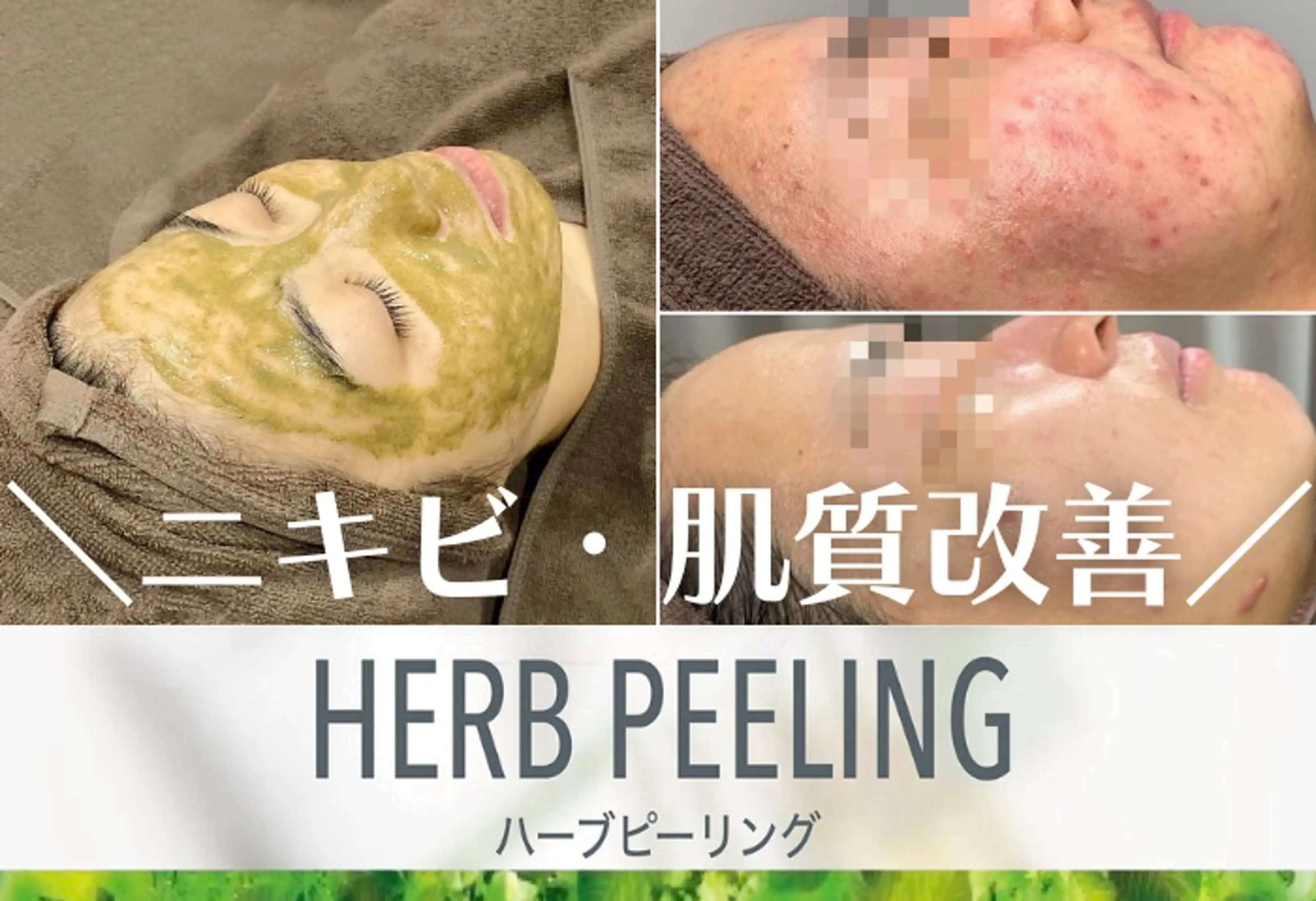 今だけ限定50%off❣️【お試しWハーブピーリング＋肌チェック🌿90分¥9900】ニキビ/毛穴/肌質改善/くすみの写真