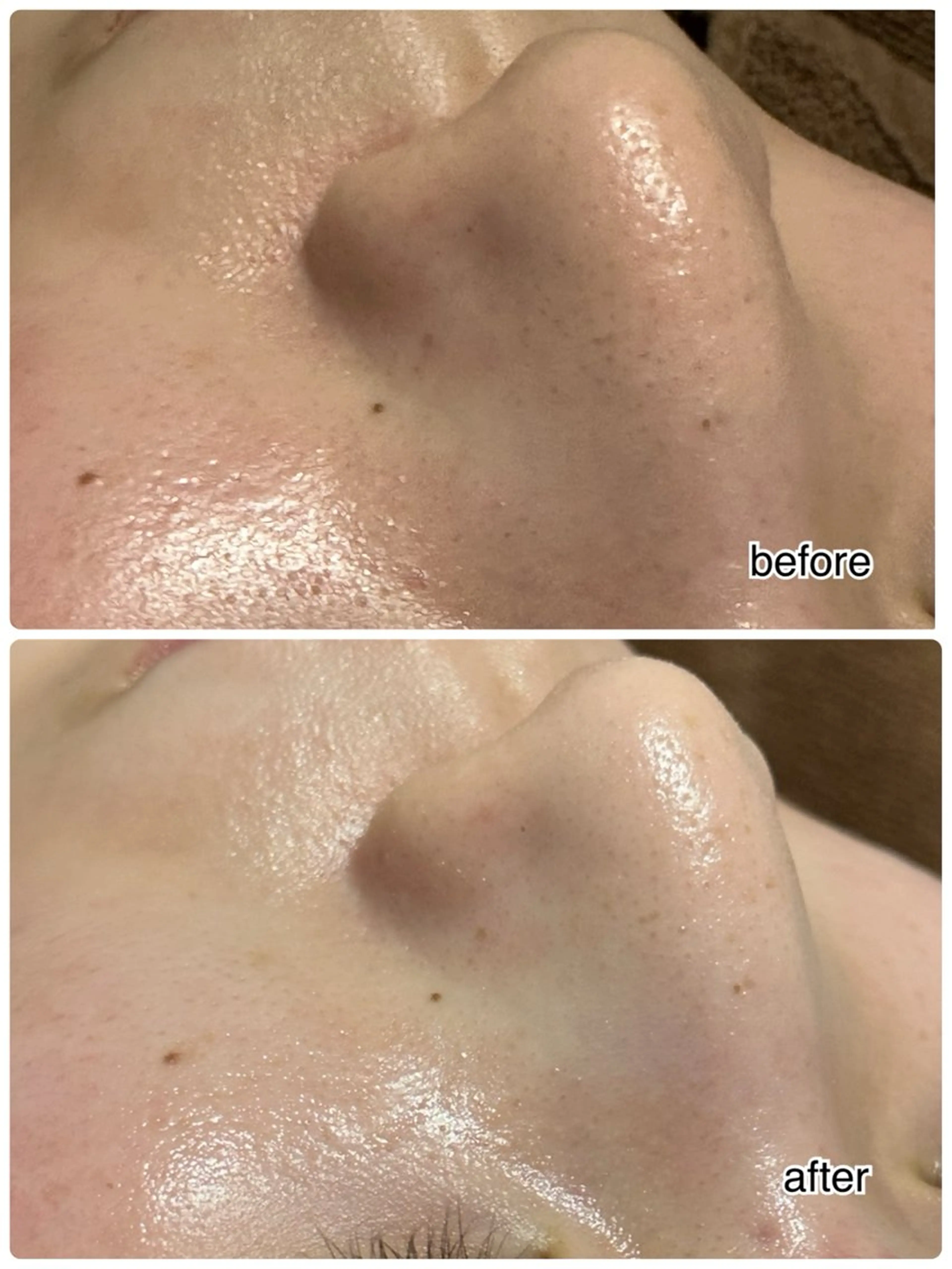 【当日限定価格】毛穴詰まり,黒ずみスッキリ✨ハイドラフェイシャル(毛穴洗浄)🫧の写真