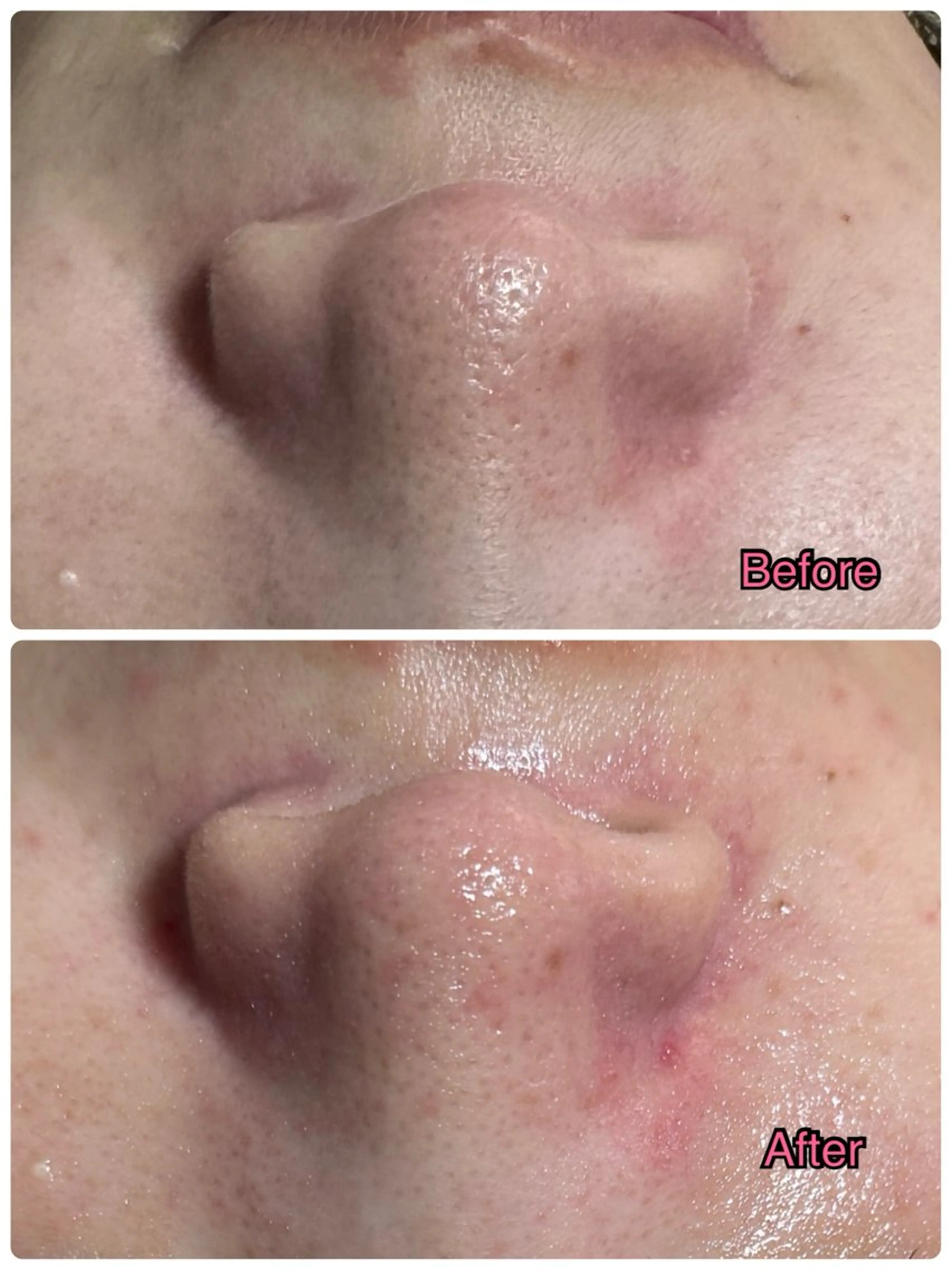 ☆大人気☆毛穴洗浄 エステブリランテのエステ・リラクイメージ