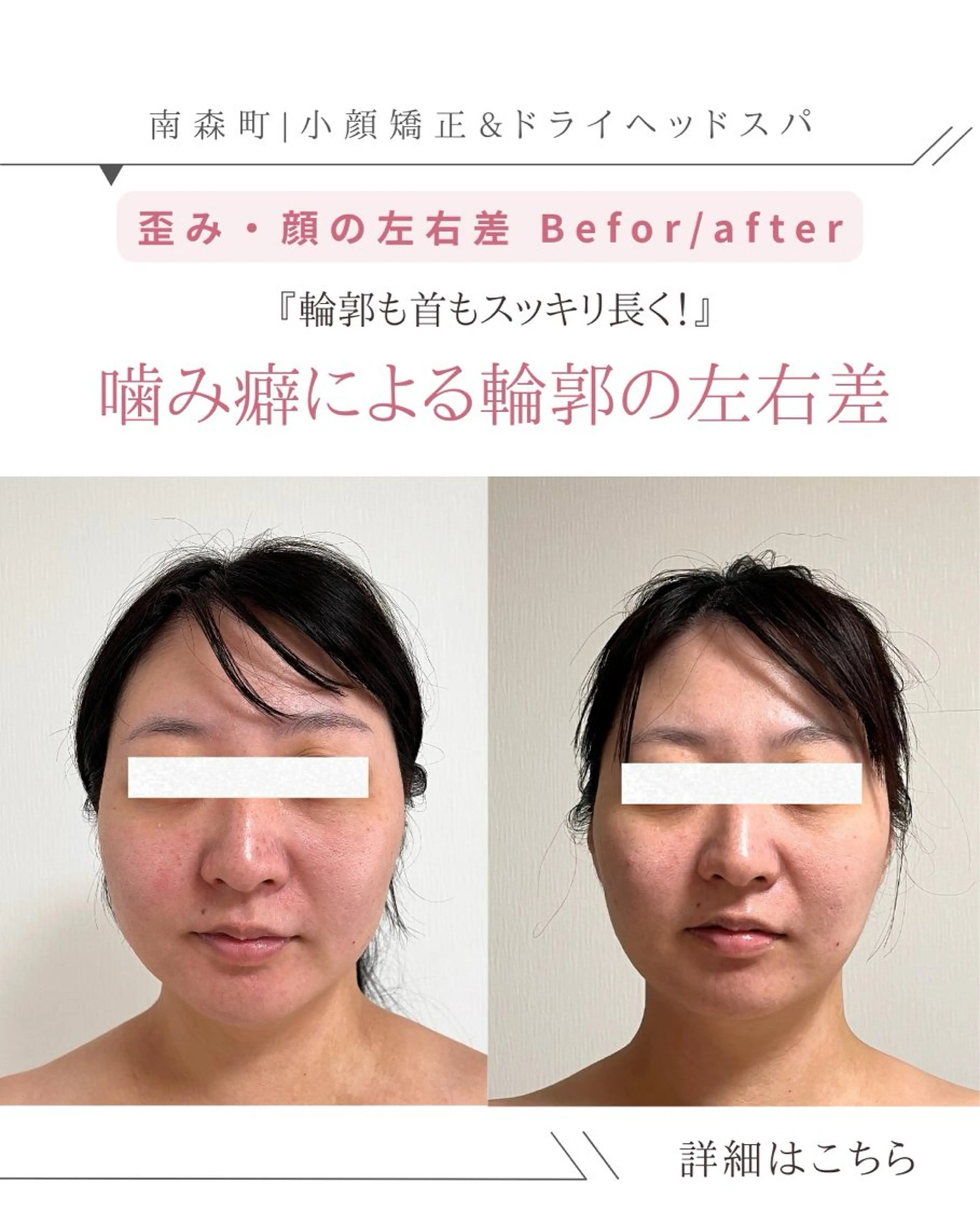 🌿 30代限定 3ヶ月間（6回来店条件）90分【エラ張り/食いしばり解消小顔ヘッドスパ】の写真