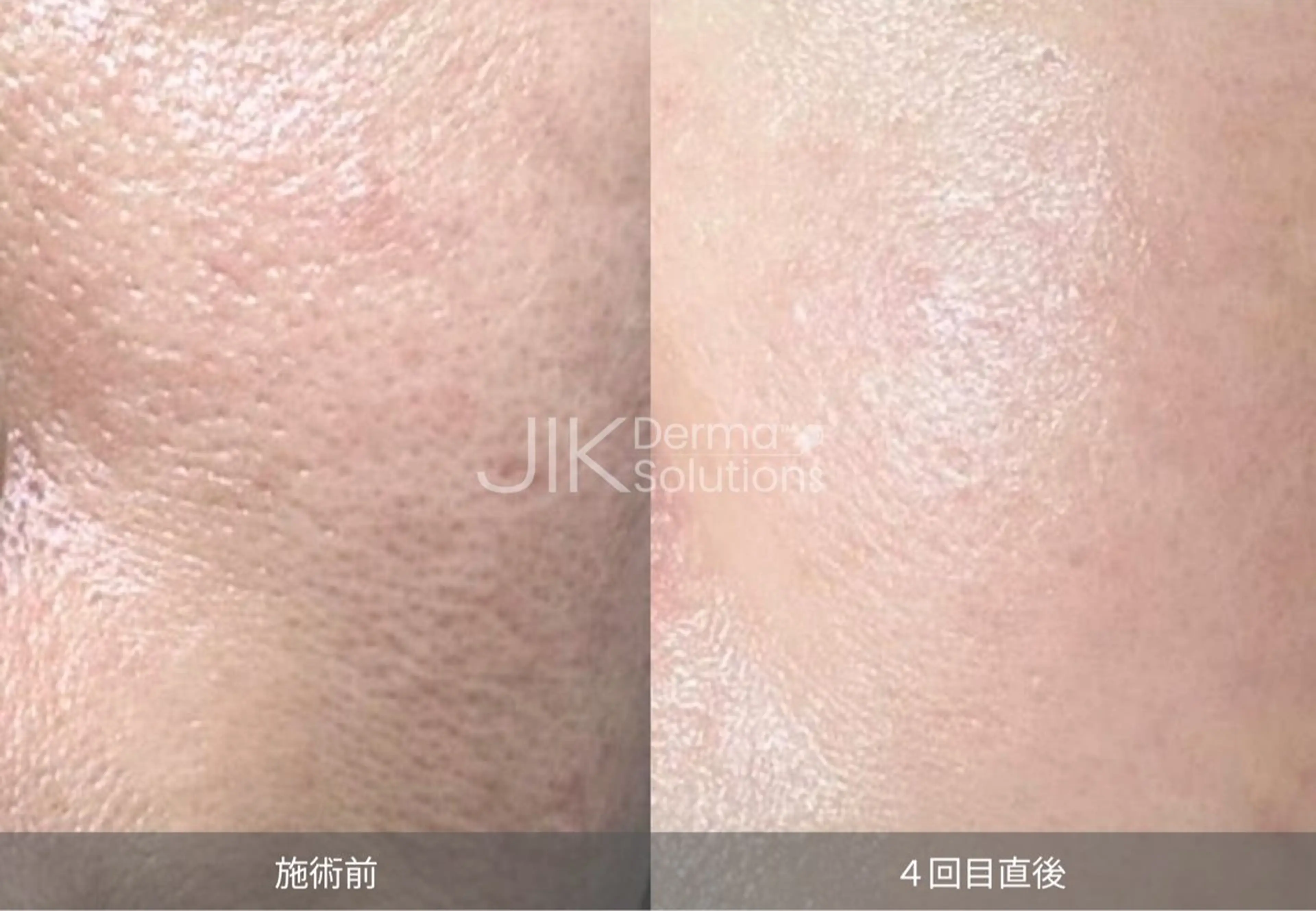 エステ WAX脱毛/肌質改善 眉毛とお肌のサロンのエステ・リラクイメージ