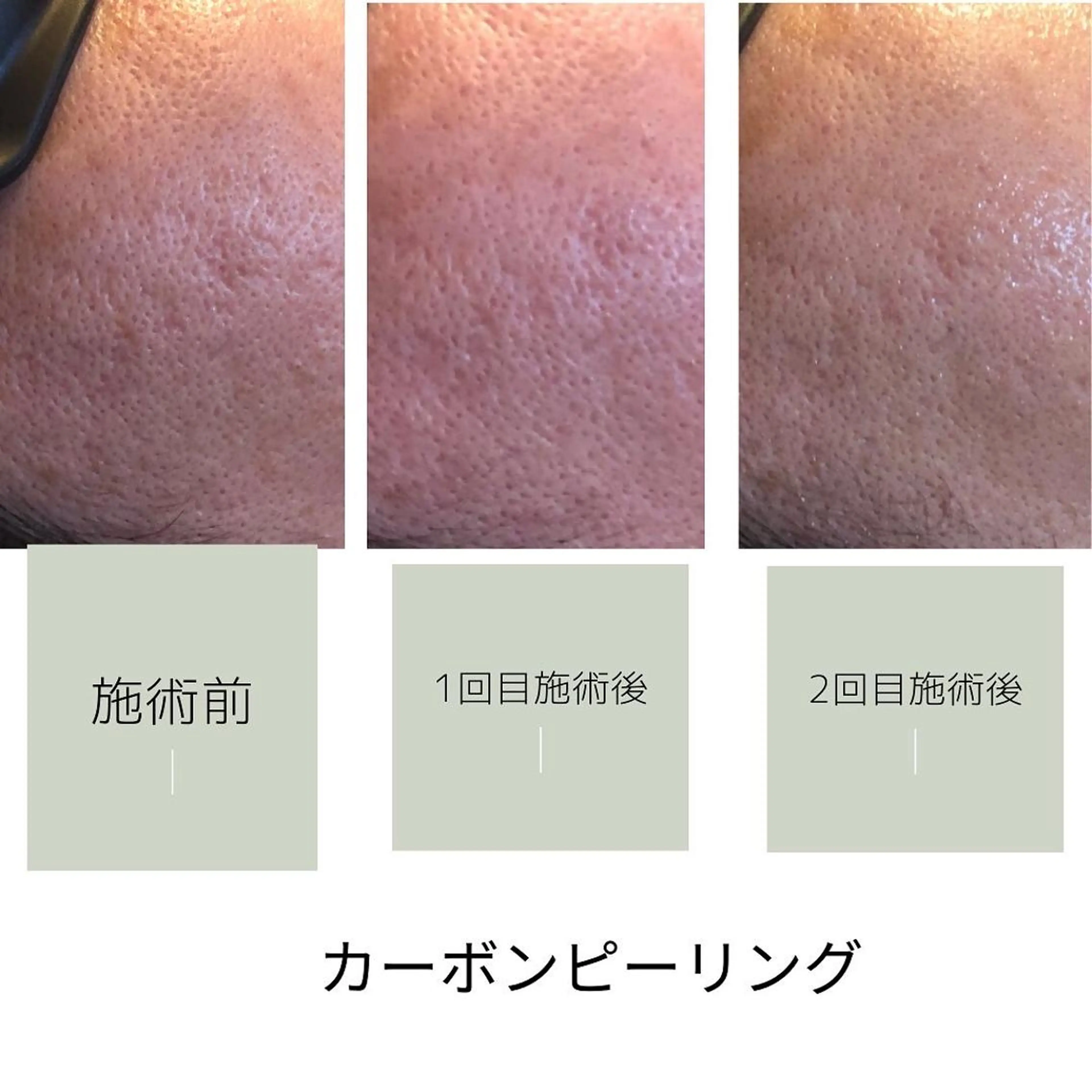 カーボンピーリングの写真