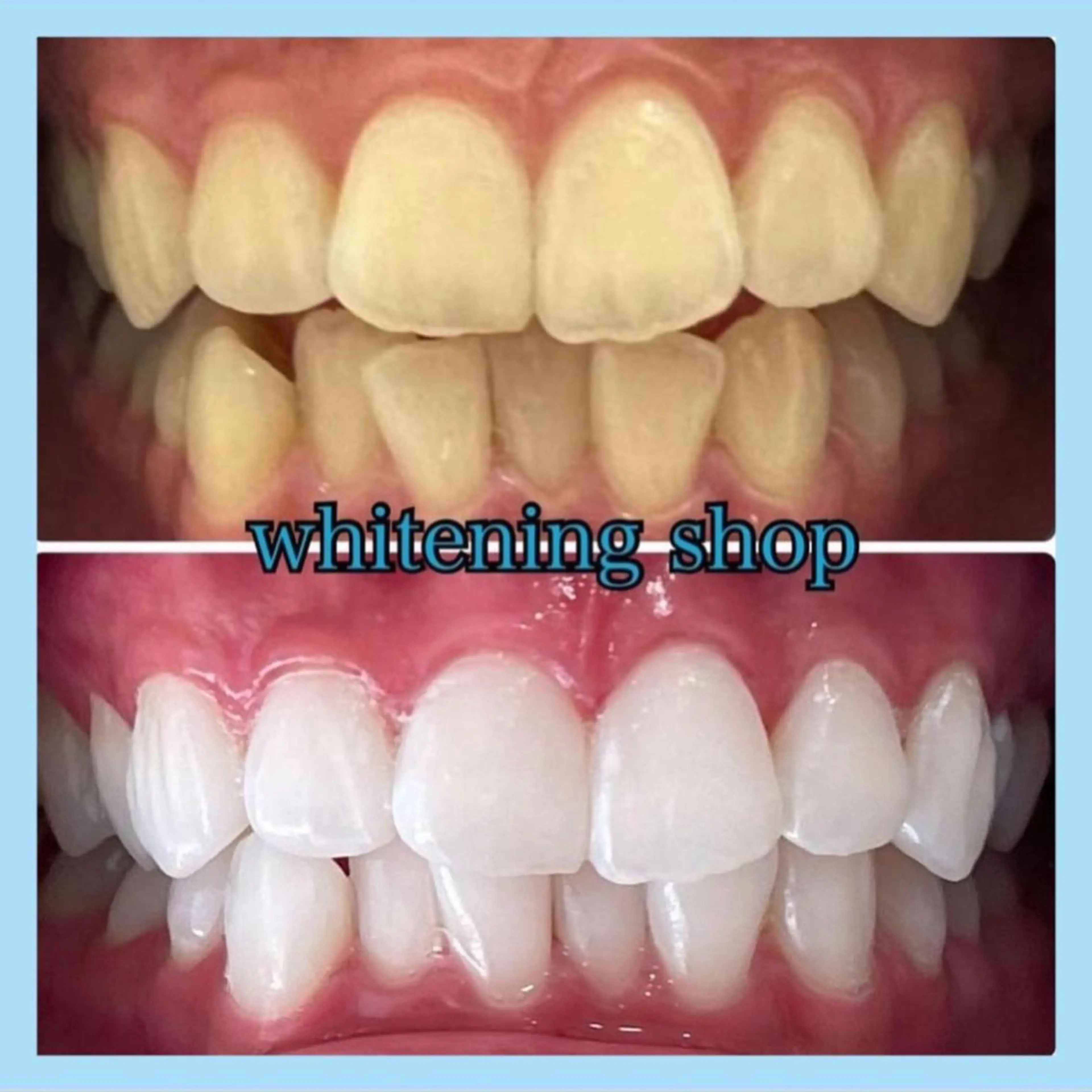 【人気No. 1 フリーパス】美白セルフホワイトニング20分×20回￥59,400⇒￥43,000（１０回来店)の写真