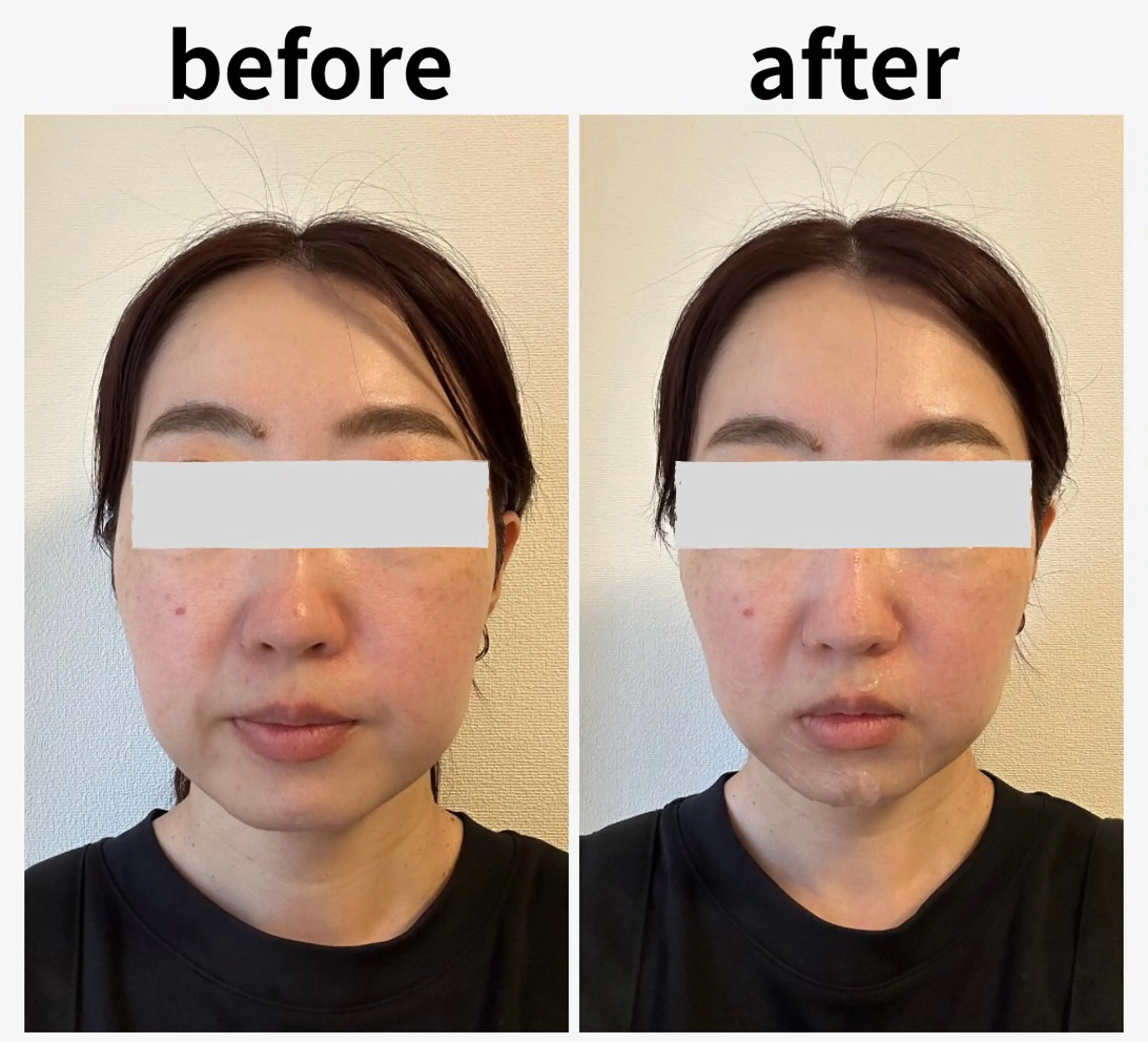 人気No.3🥉光フェイシャルエステ＋毛穴イオン洗浄＋美容液ピーリング✨️【毛穴/たるみ/小顔/肌荒れ/顔脱毛へ変更可】の写真