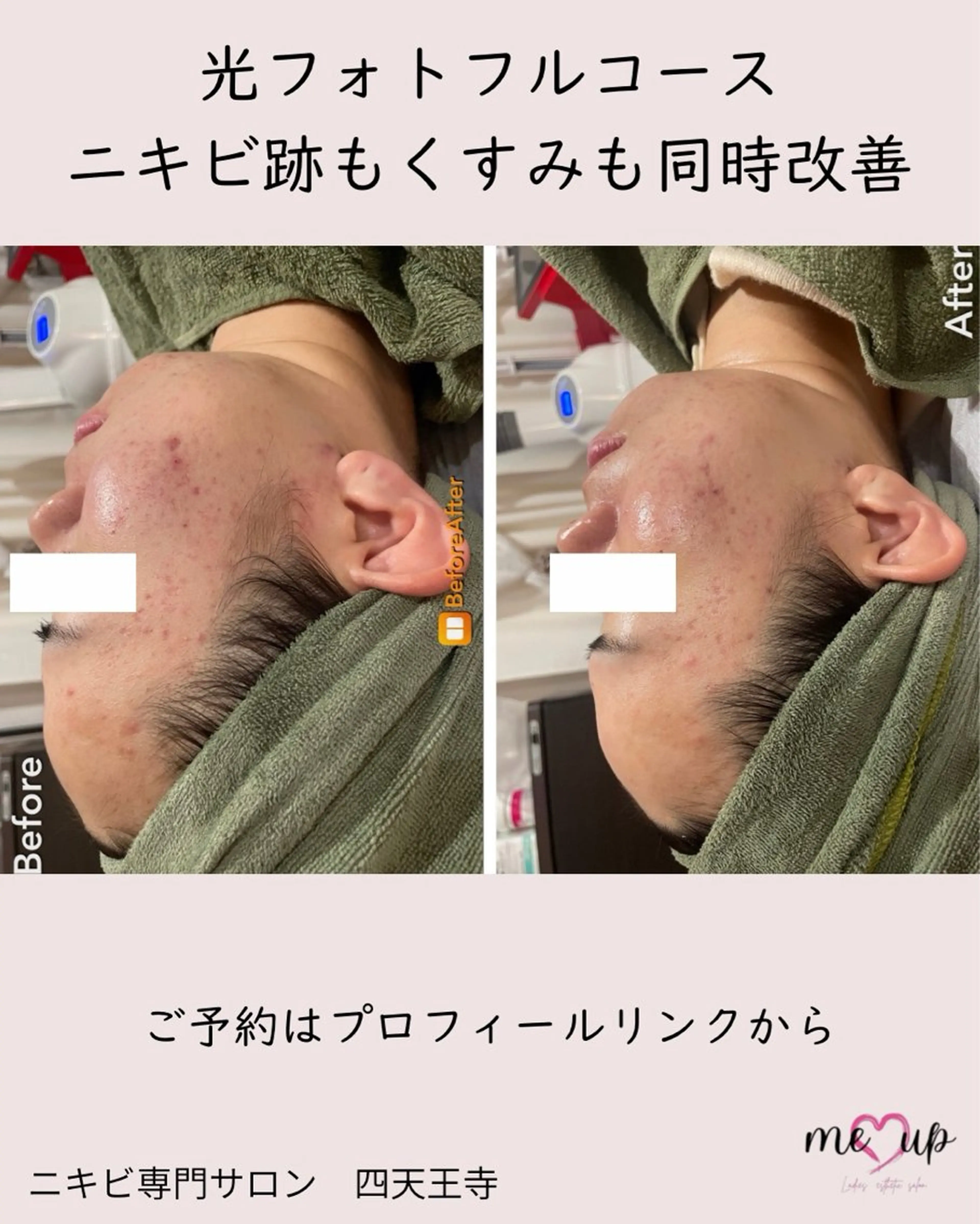 エステ Meupニキビ専門店 背中/ハーブ/肌管理のその他イメージ