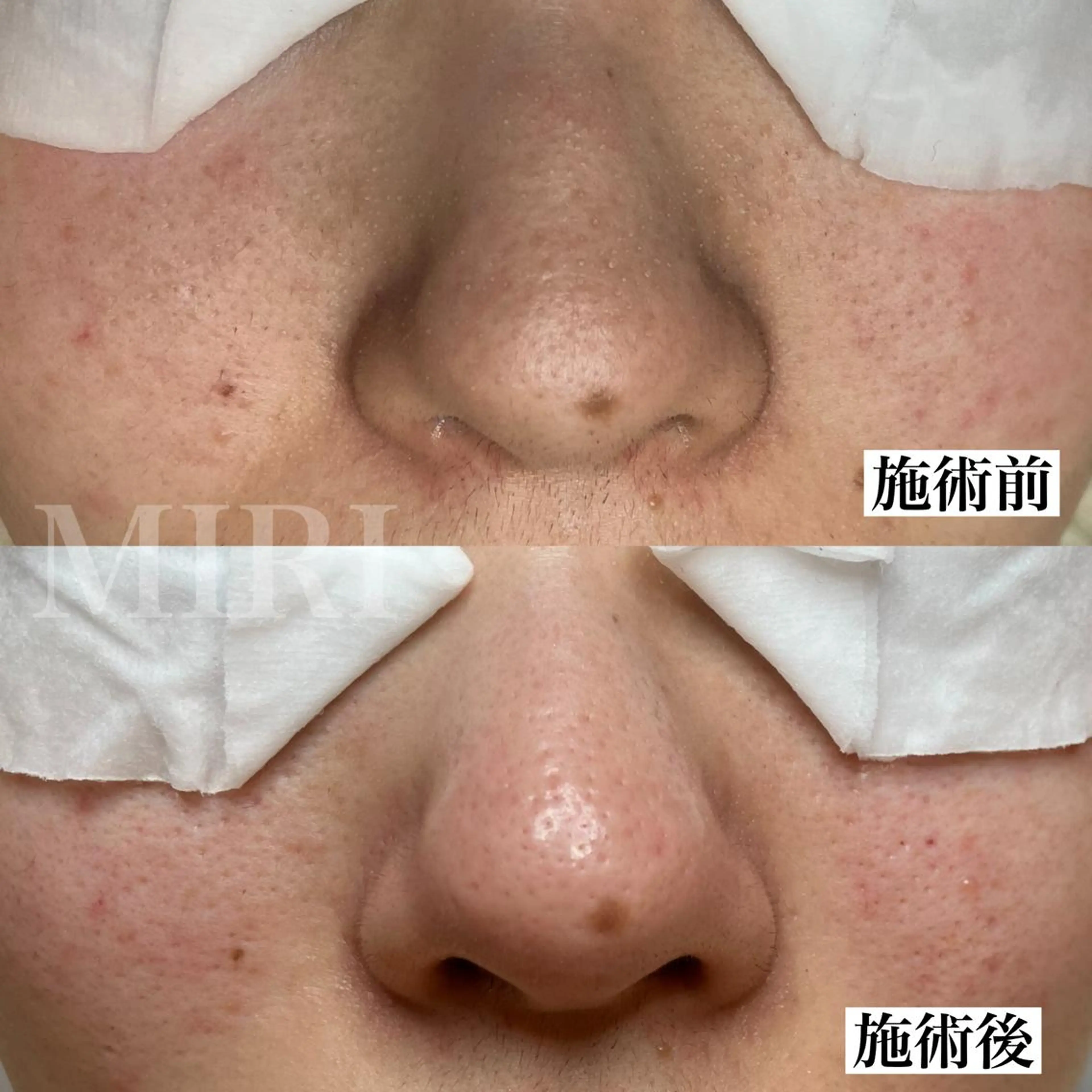 エステ MIRI所属・北堀江/毛穴改善専門 ミリのエステ・リラクイメージ