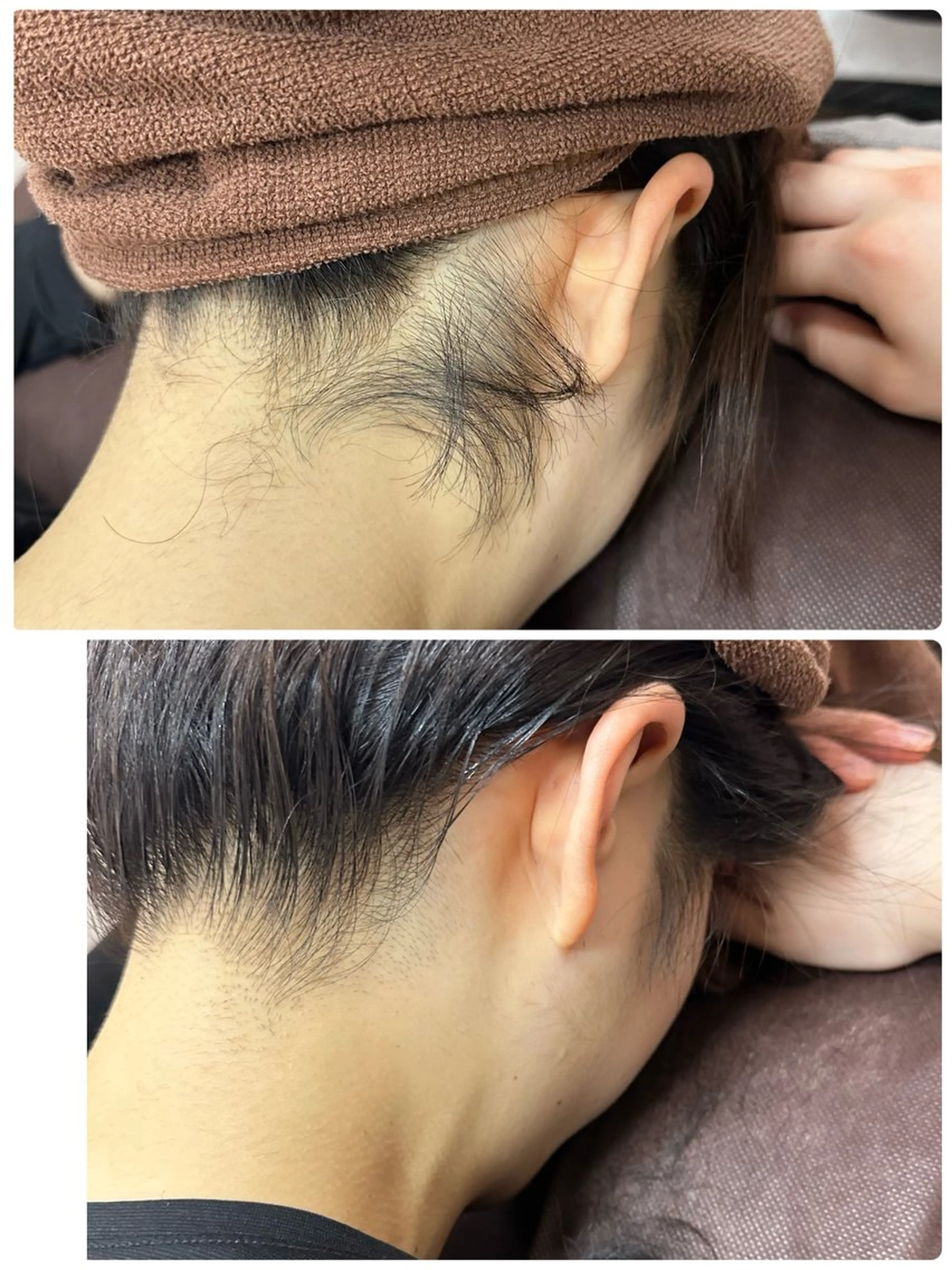 女子力アップ♡うなじ脱毛の写真