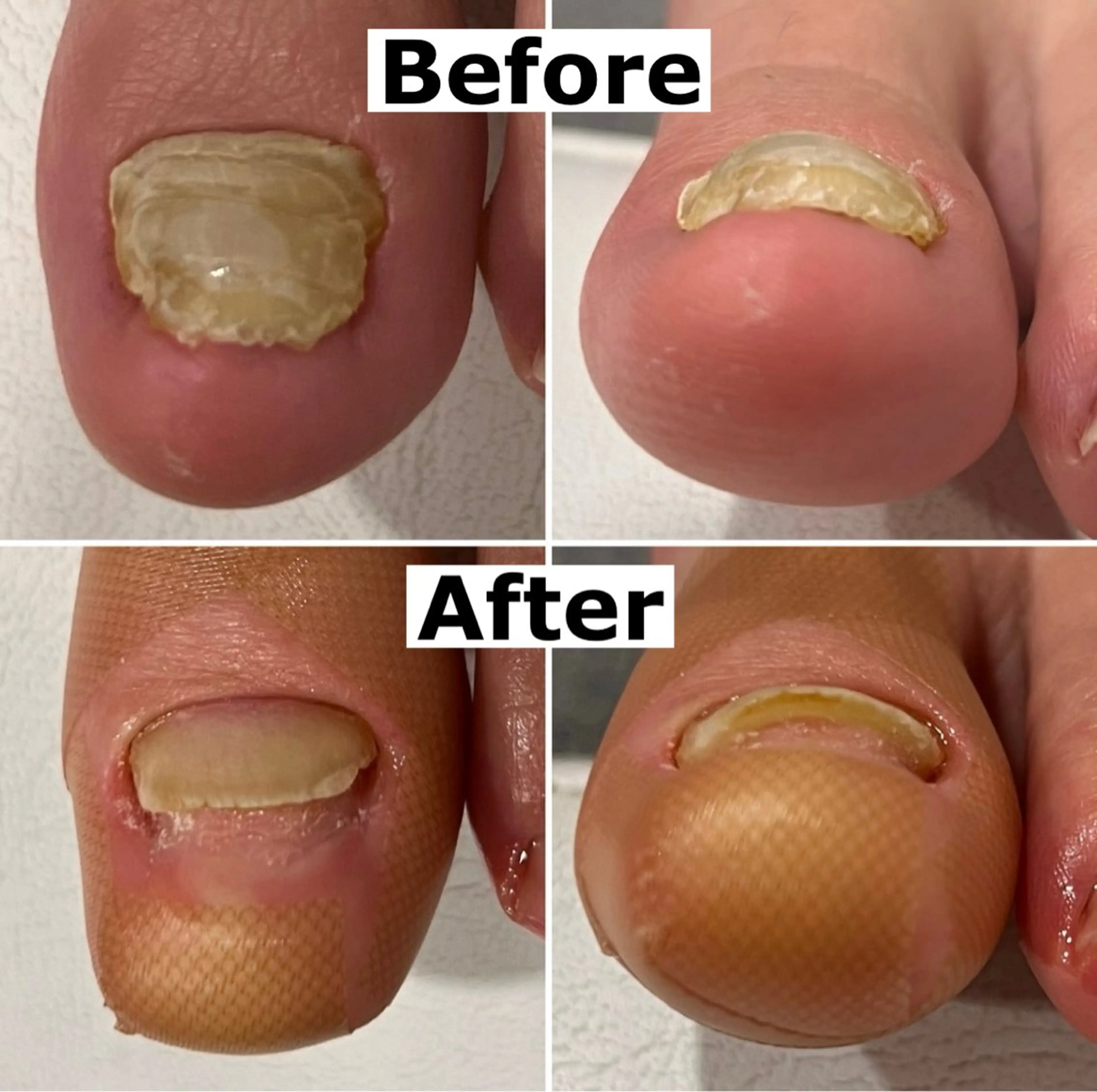 ネイル 巻爪無料モデル募集 ✨🦶MEGUMIのネイルデザイン