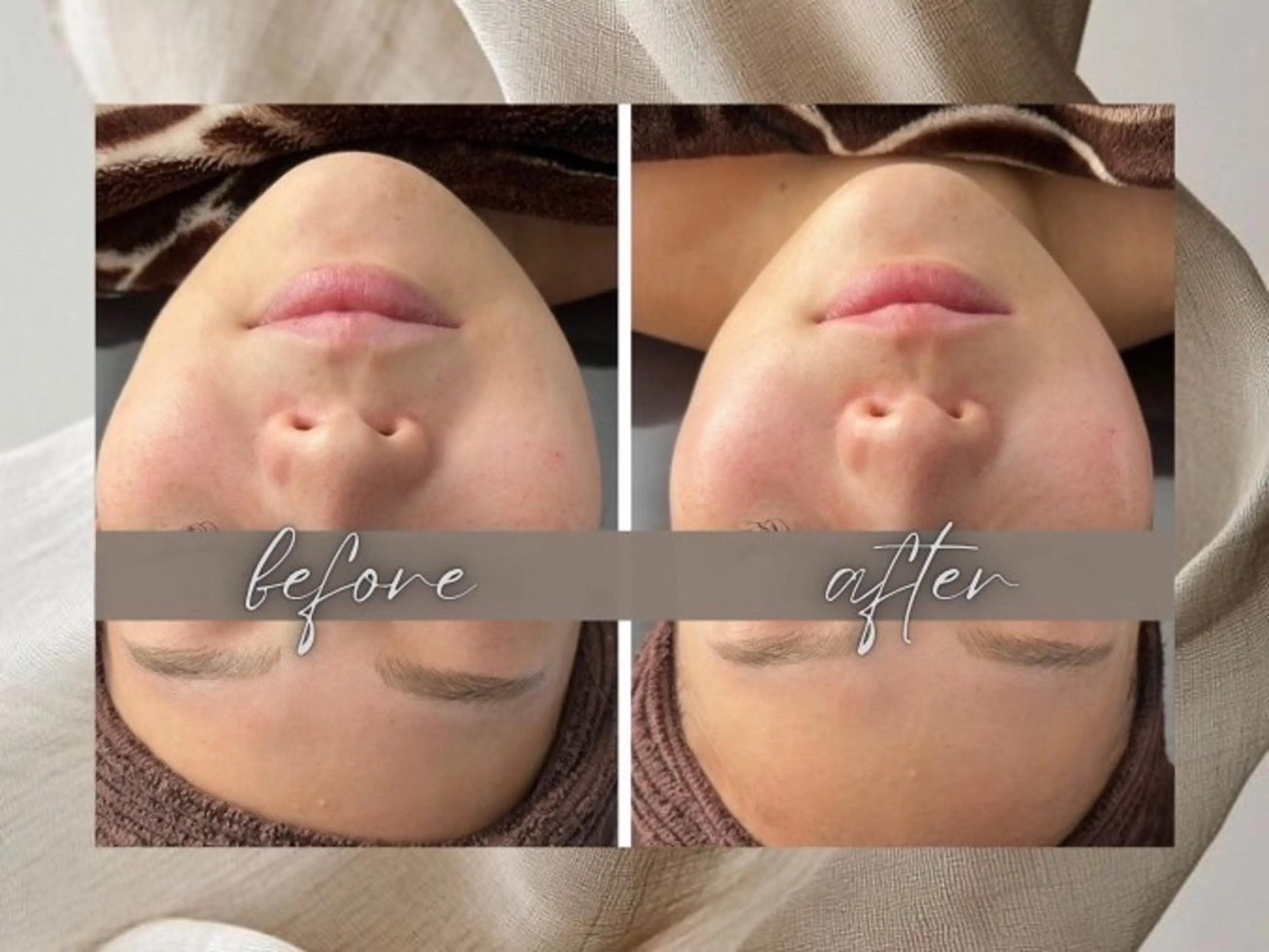 小顔・毛穴/ニキビ/ ハーブピーリング専門のエステ・リラクイメージ