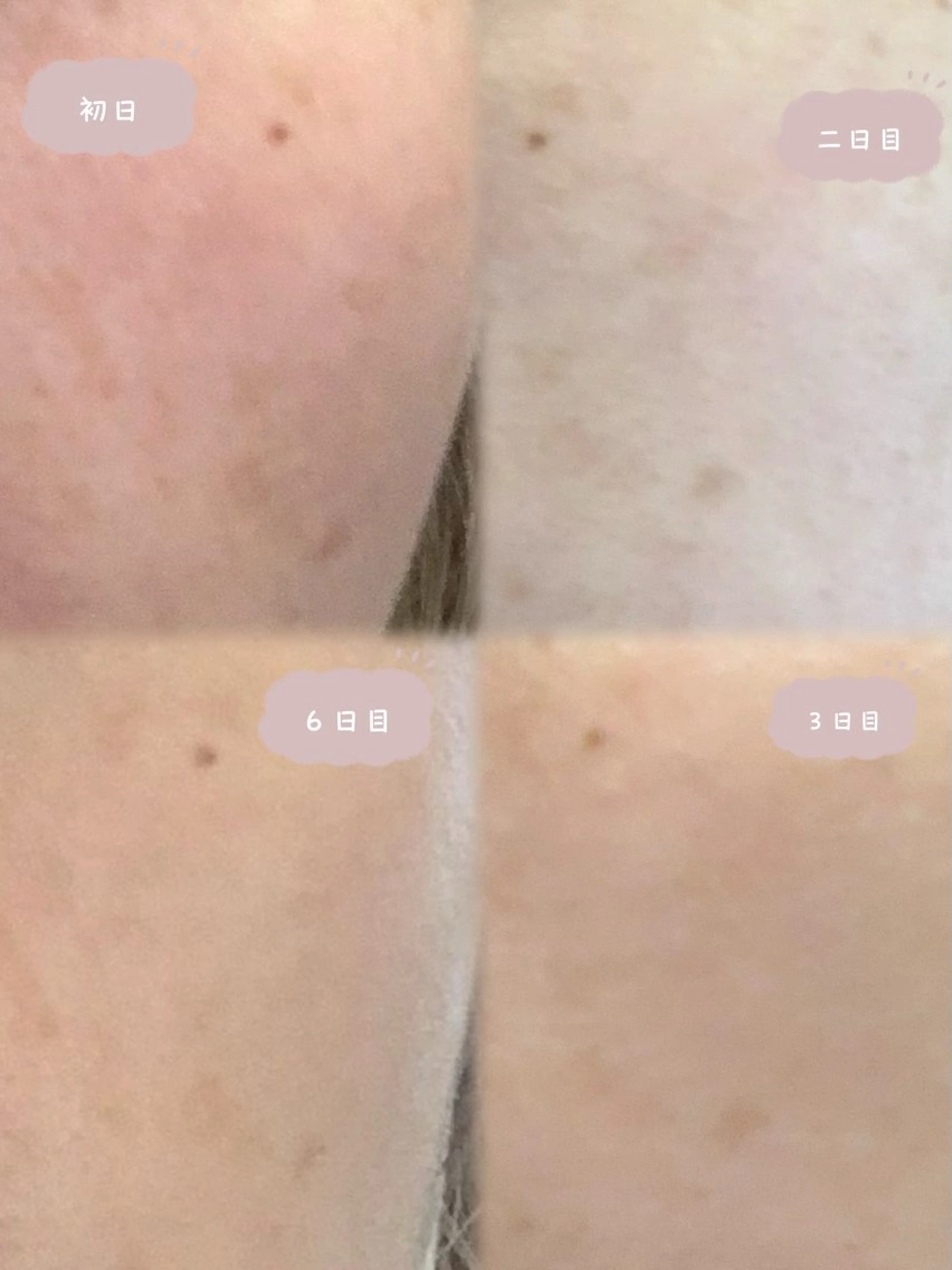 赤ちゃん肌を目指す!シミケア🌿ハーブピーリング+アフターフォロー付の写真