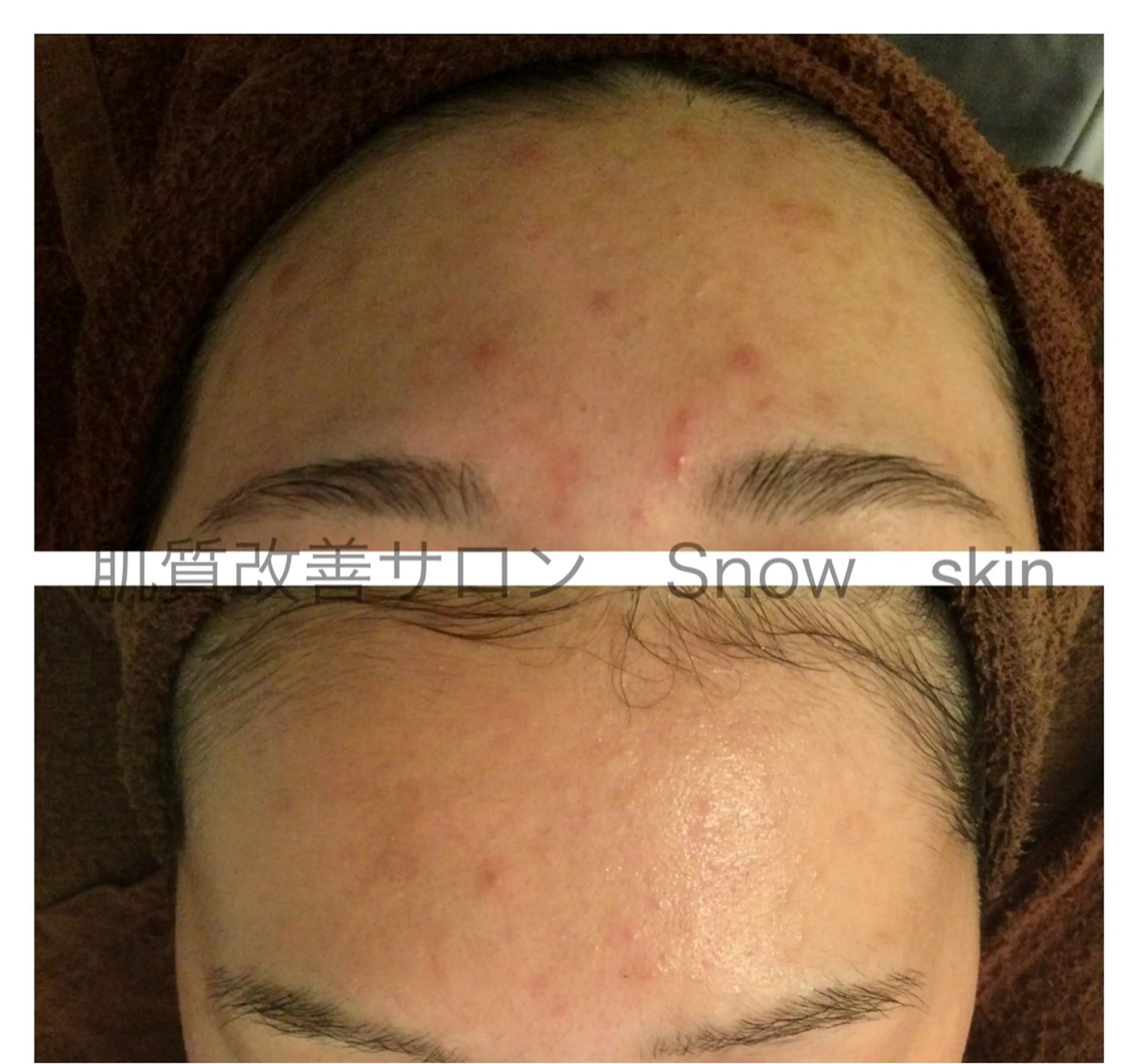 エステ リラク ニキビ/肌質改善専門 Snow skinのエステ・リラクイメージ