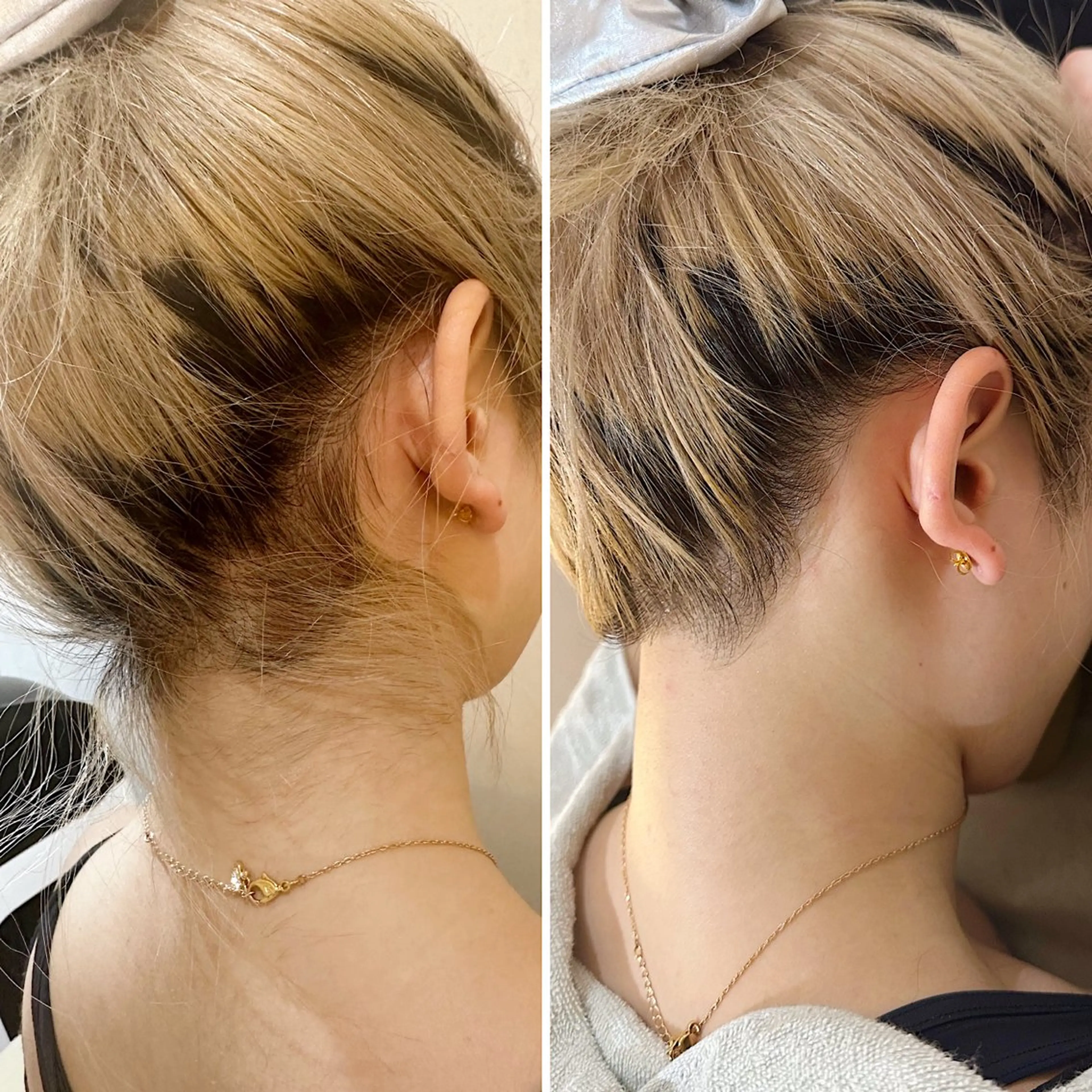 脱毛 うなじ脱毛/美肌脱毛 LABELのエステ・リラクイメージ