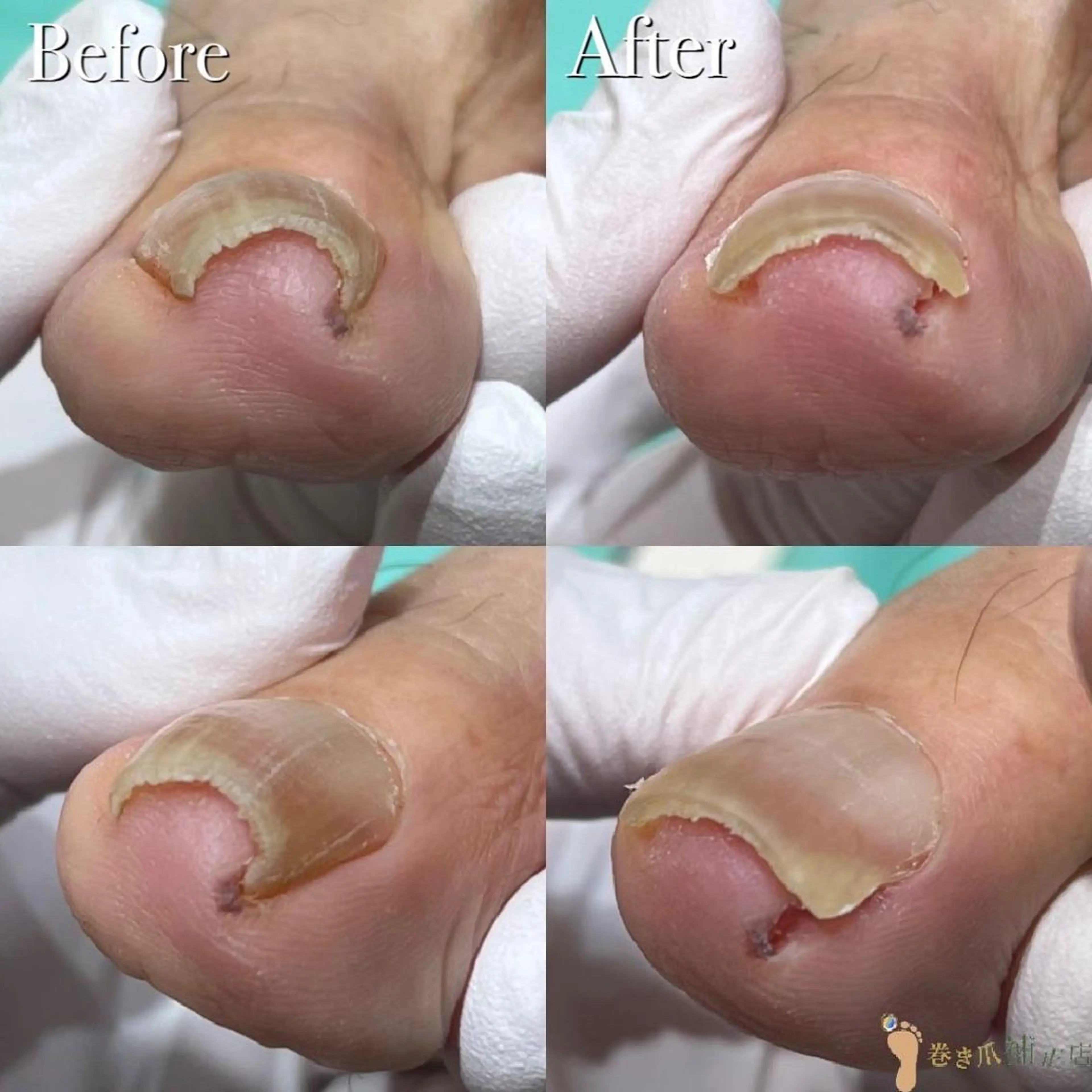 ネイル 東京巻き爪 アカデミーのエステ・リラクイメージ