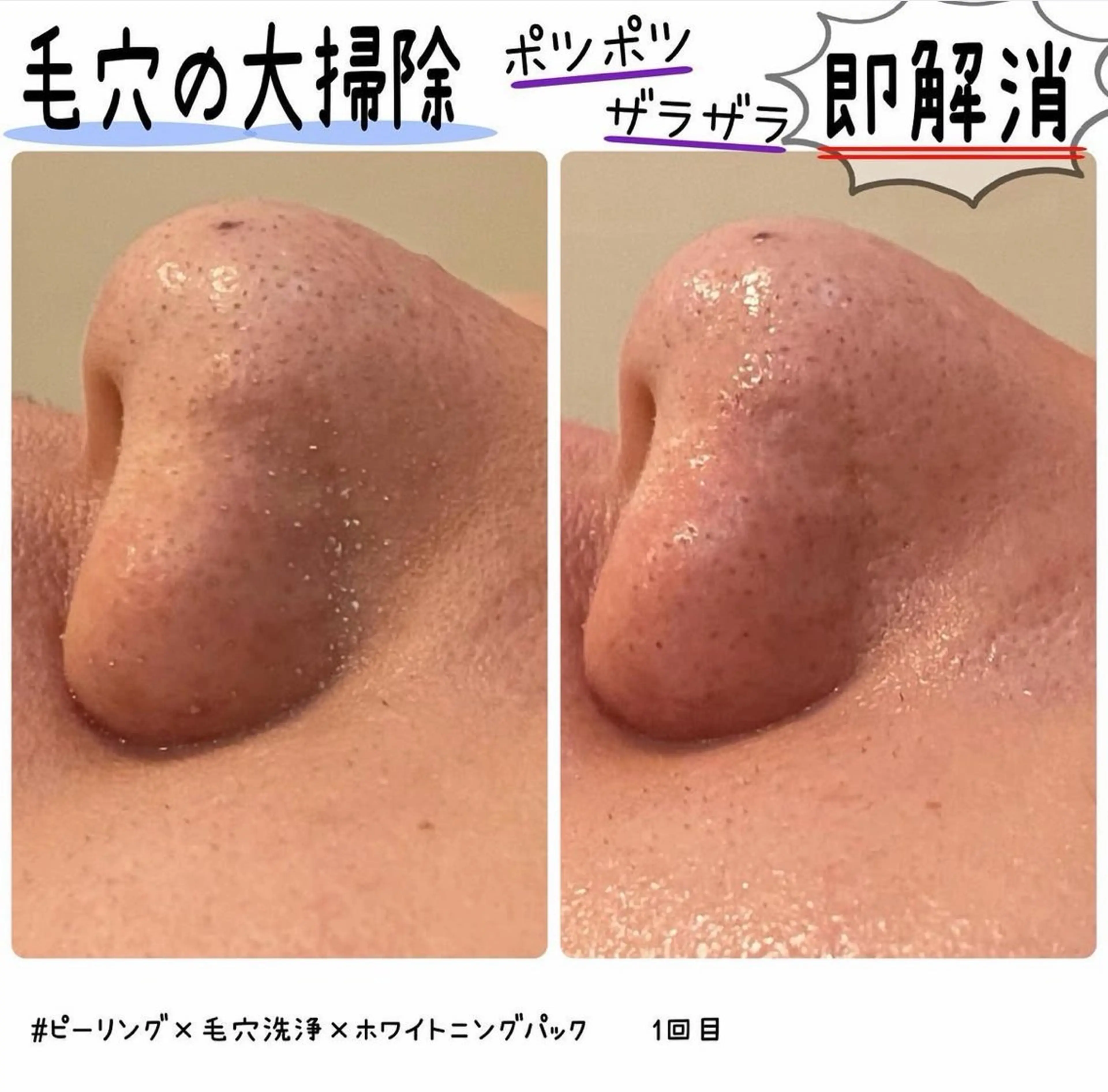 ニキビケア/化粧崩れ卒業🙆‍♀️✨ソフトピーリング毛穴洗浄+ホワイトクリアパック¥5,500の写真