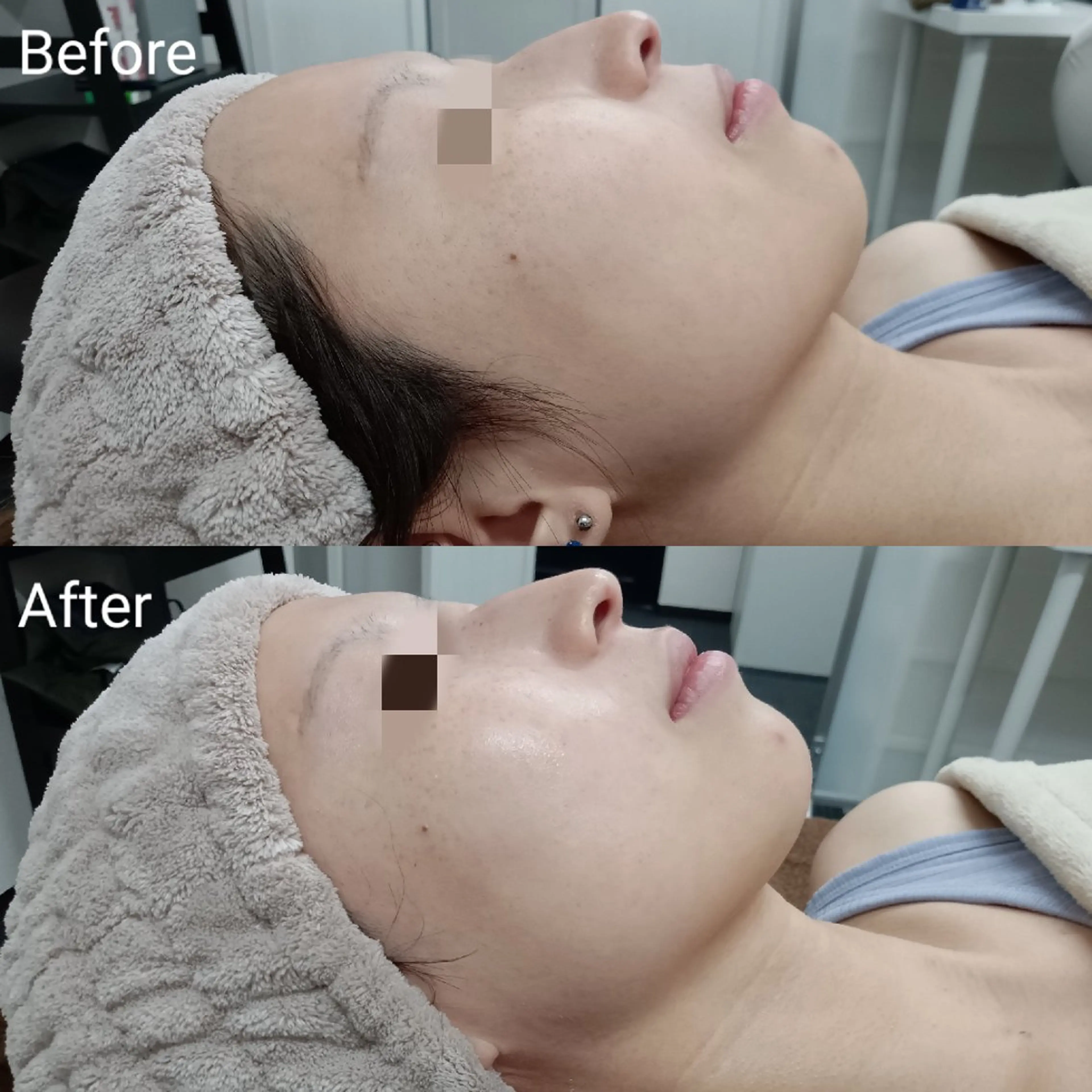 即効！小顔💖ゾンビマスク＆ハイドロジェリーマスク《シワ/リフトアップ/毛穴/ハリ･ツヤ/高保湿》の写真