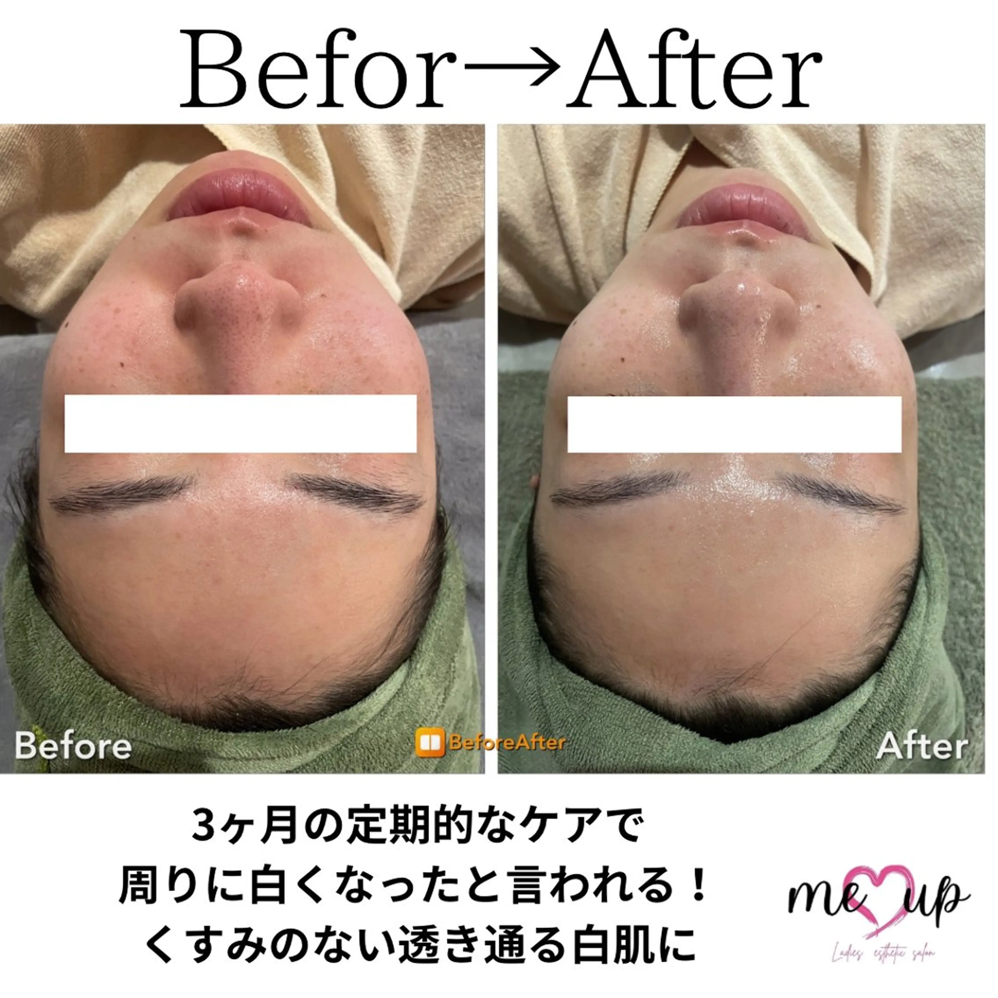 エステ Meupニキビ専門店 背中/ハーブ/肌管理のその他イメージ