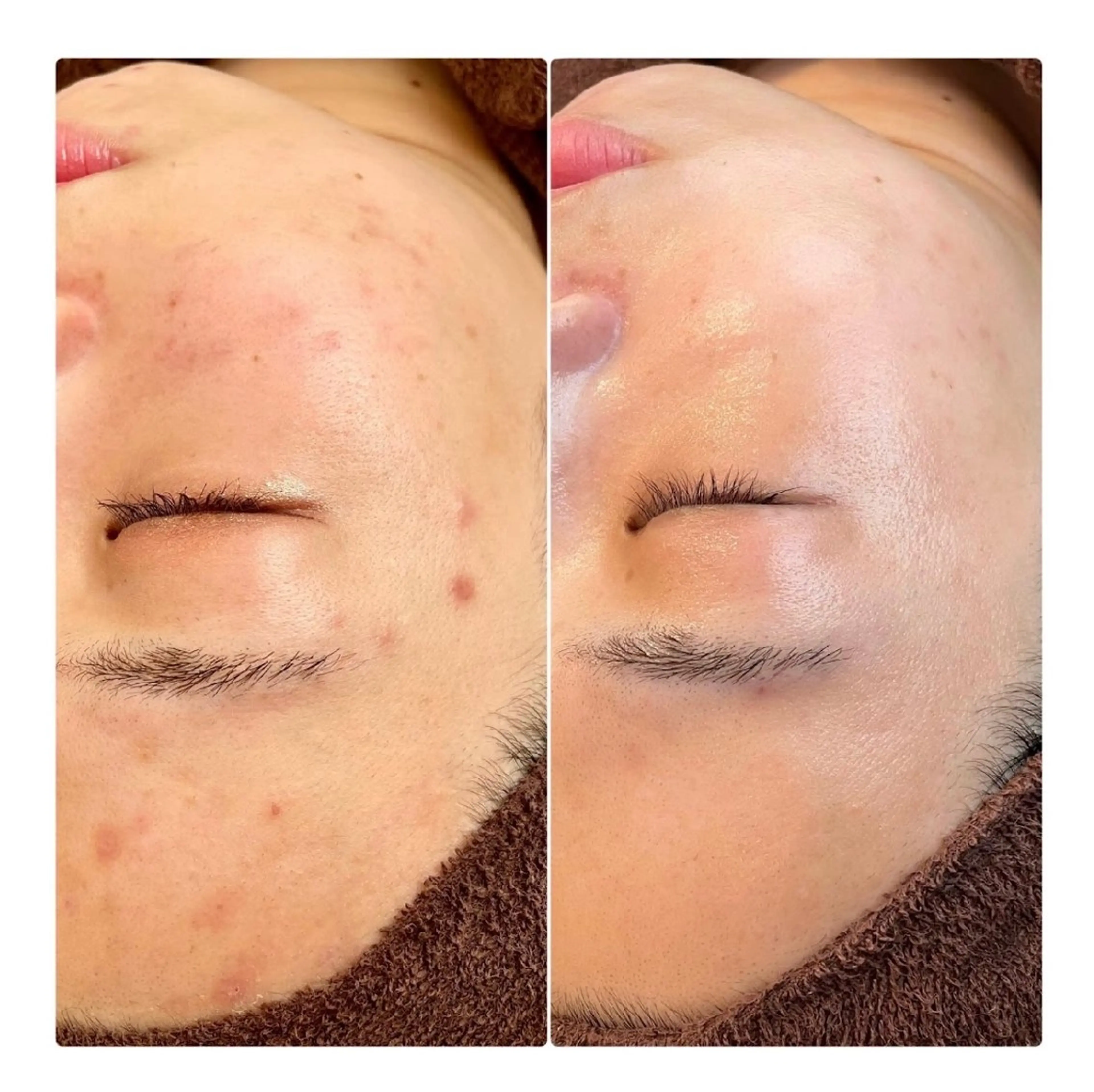 🌿【30%濃度幹細胞培養液導入付】 ハーブピーリング🌿の写真