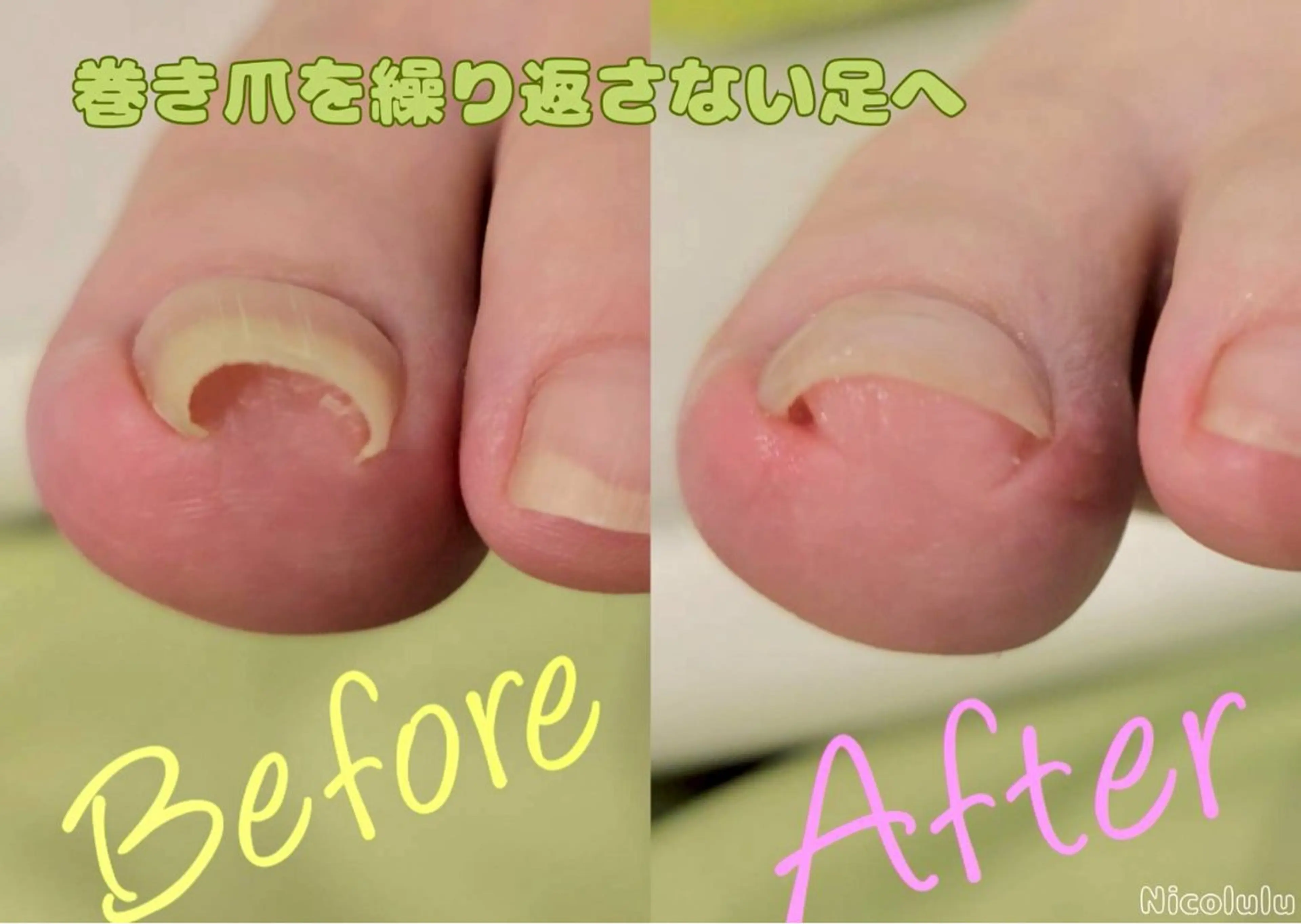 期間限定モニター【巻き爪補正！繰り返さない！】改善 12800→5000の写真