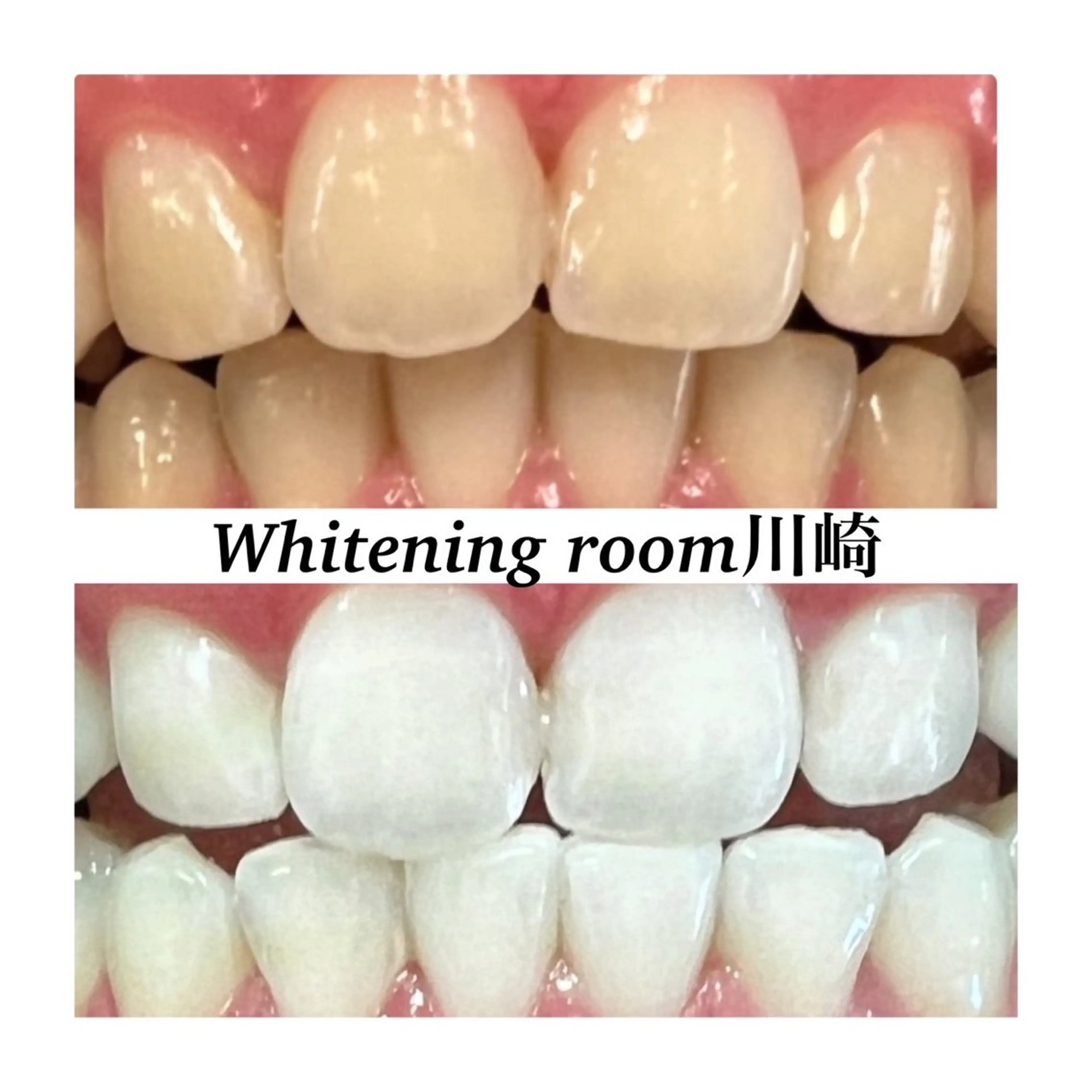 【ミニモ学割】学生限定★ セルフホワイトニング30分照射×3回コース　回数券🦷💎の写真