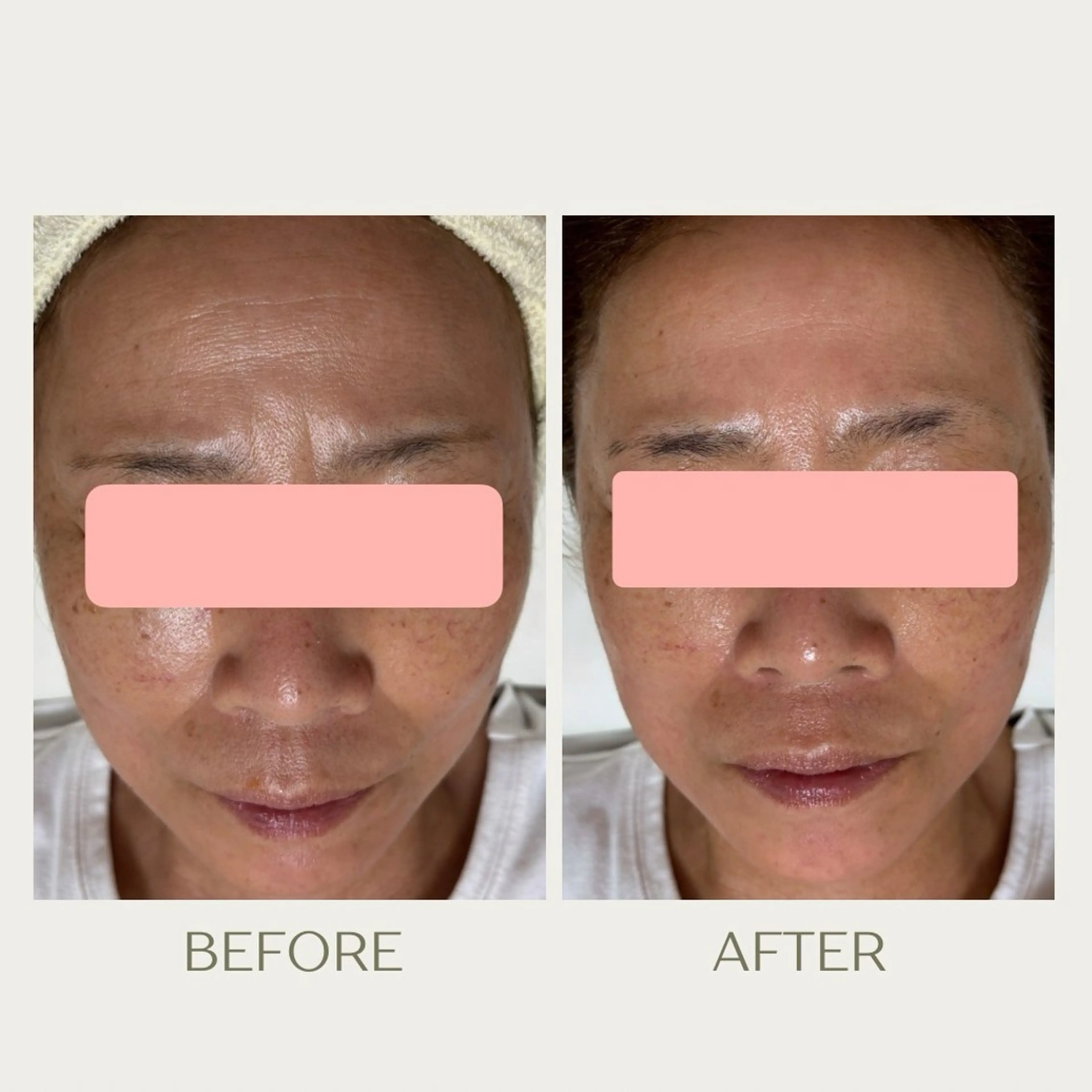 ピーリングケア 🤍moekoのその他イメージ