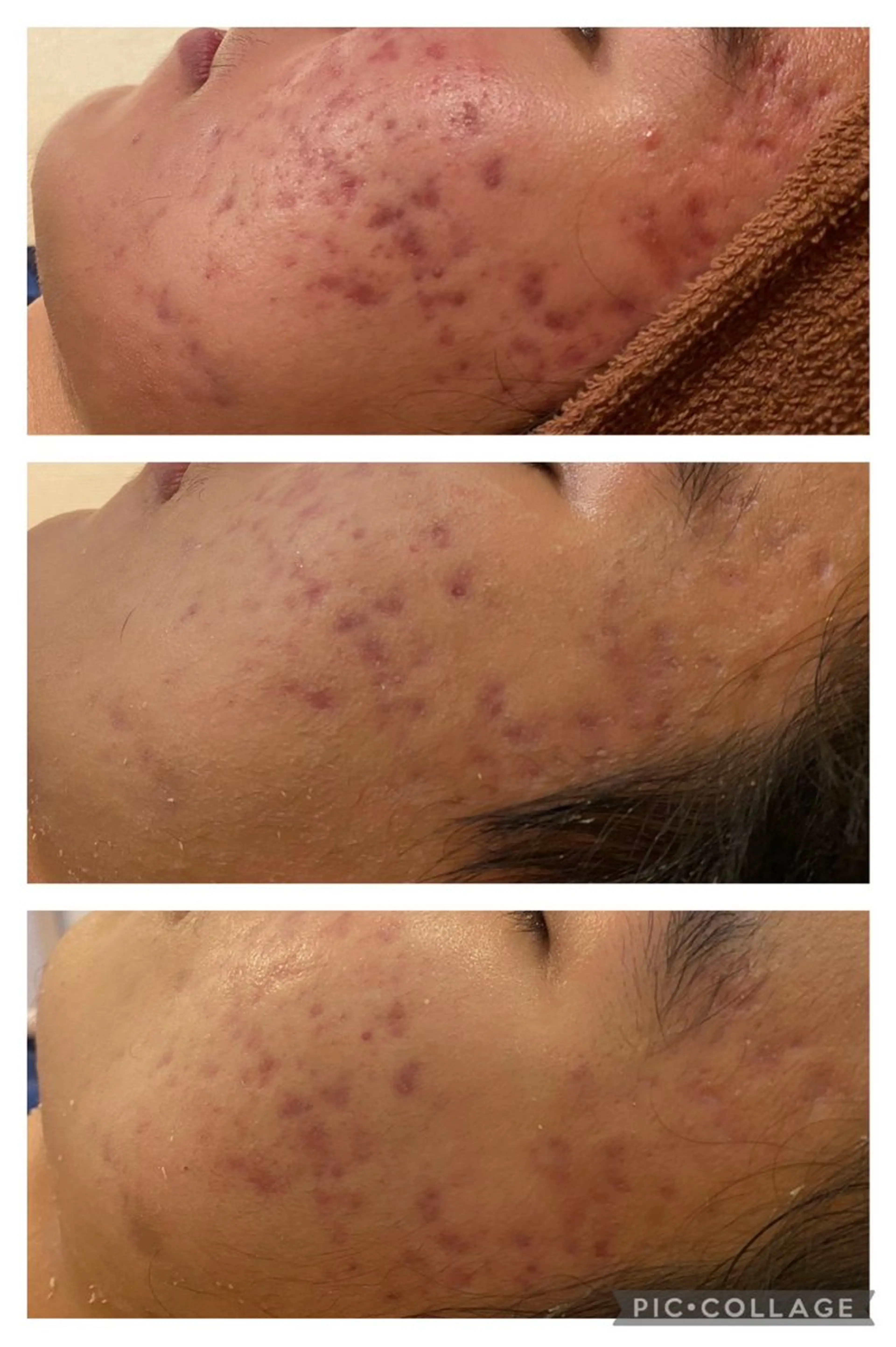 ニキビ跡改善専門🔥 医療にはできない改善のエステ・リラクイメージ