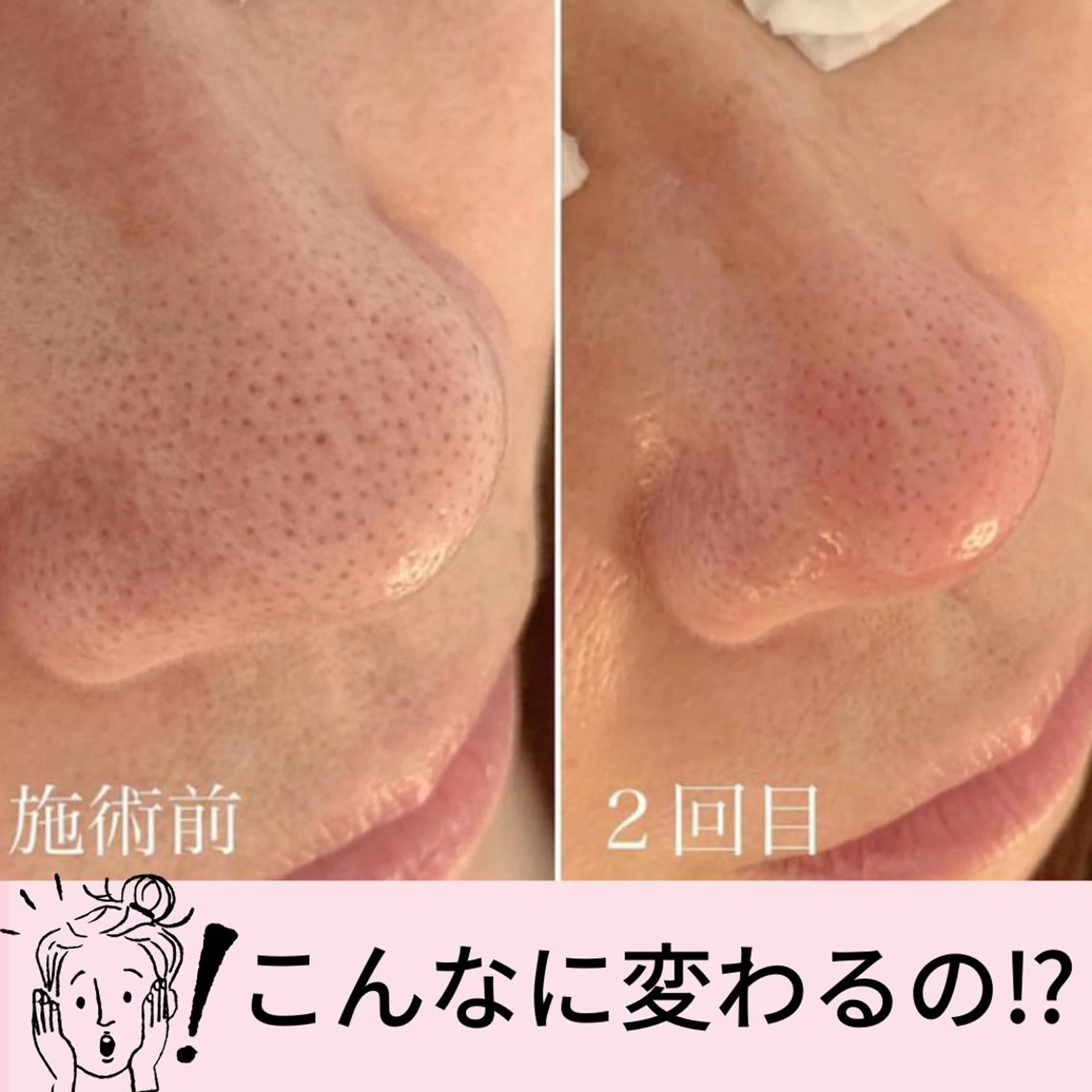 【小鼻の毛穴エクストラクション➕小顔コルギ】美肌と小顔で変化整形級✨脱マスクにむけて❤️の写真