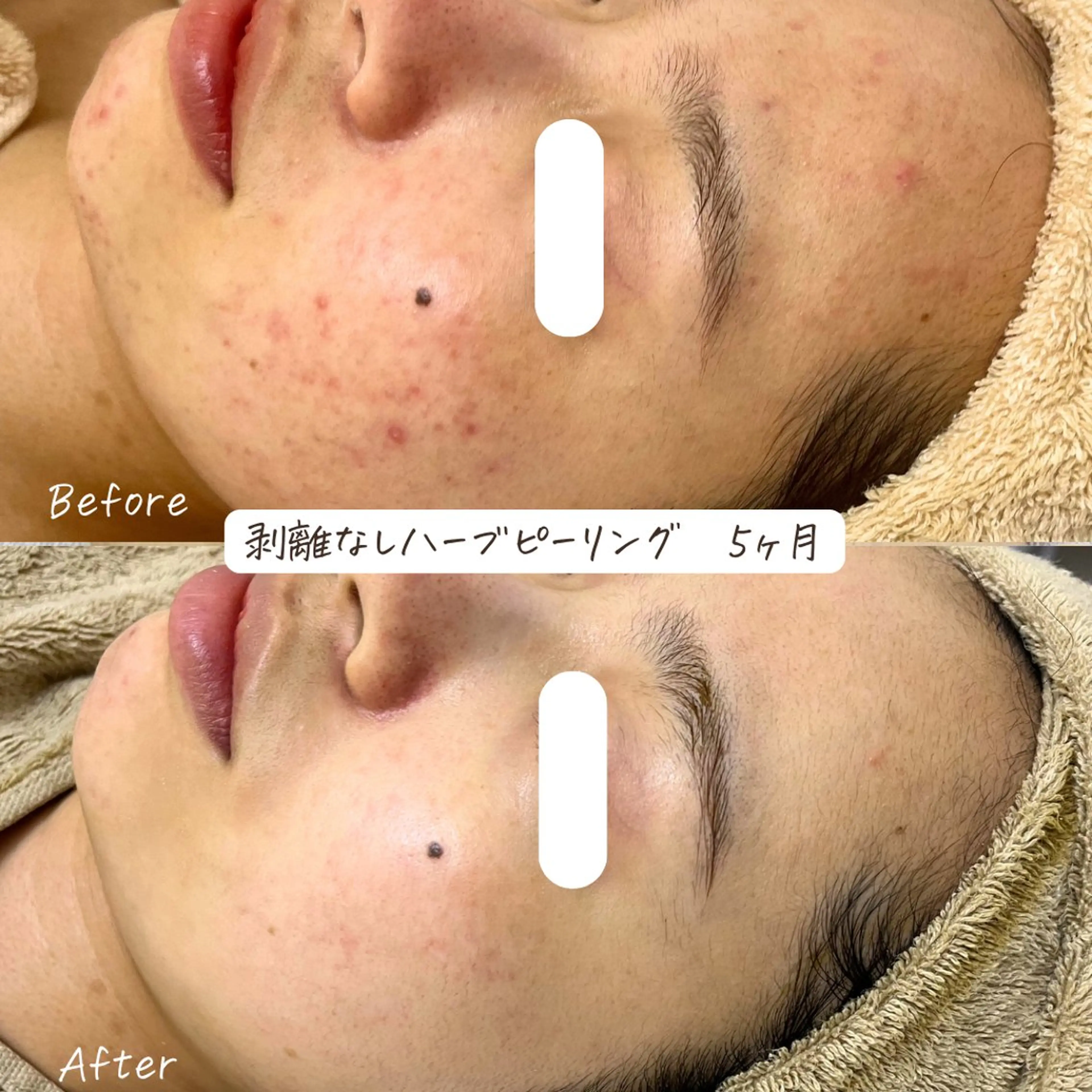 肌質改善サロン renew/ｳｴｷのエステ・リラクイメージ